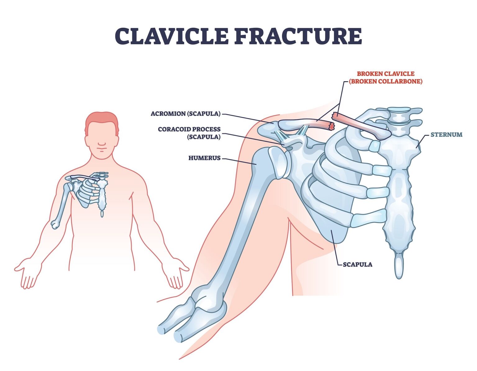 About Collarbone Clavicle Fractures Dr Kyle McClintock Roseville CA