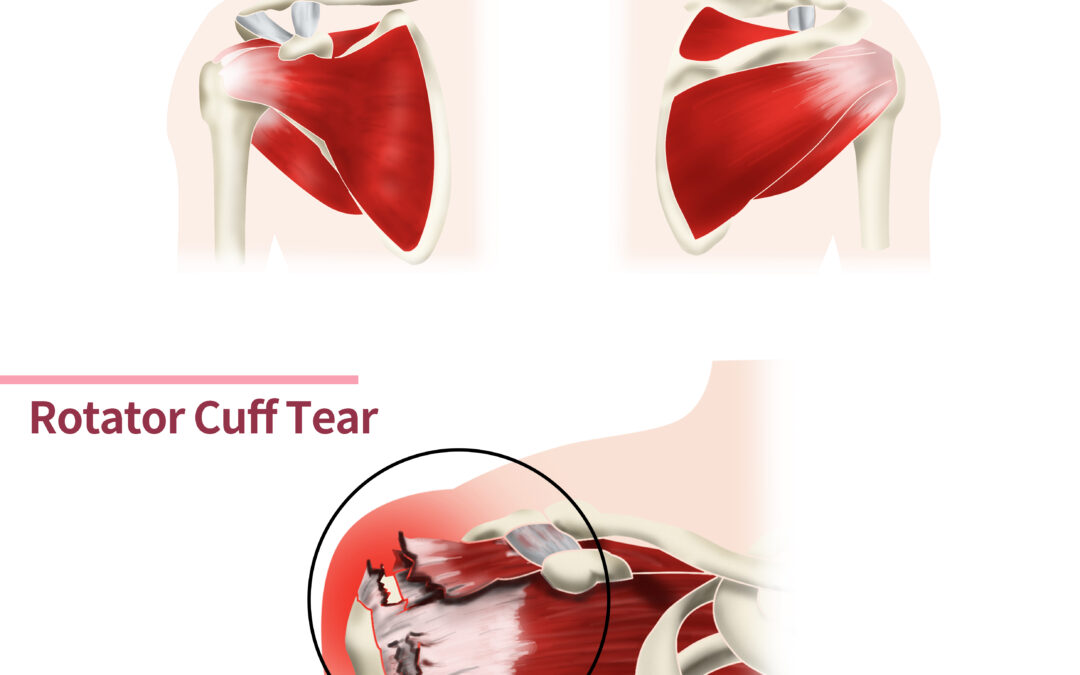 Understanding Rotator Cuff Tears