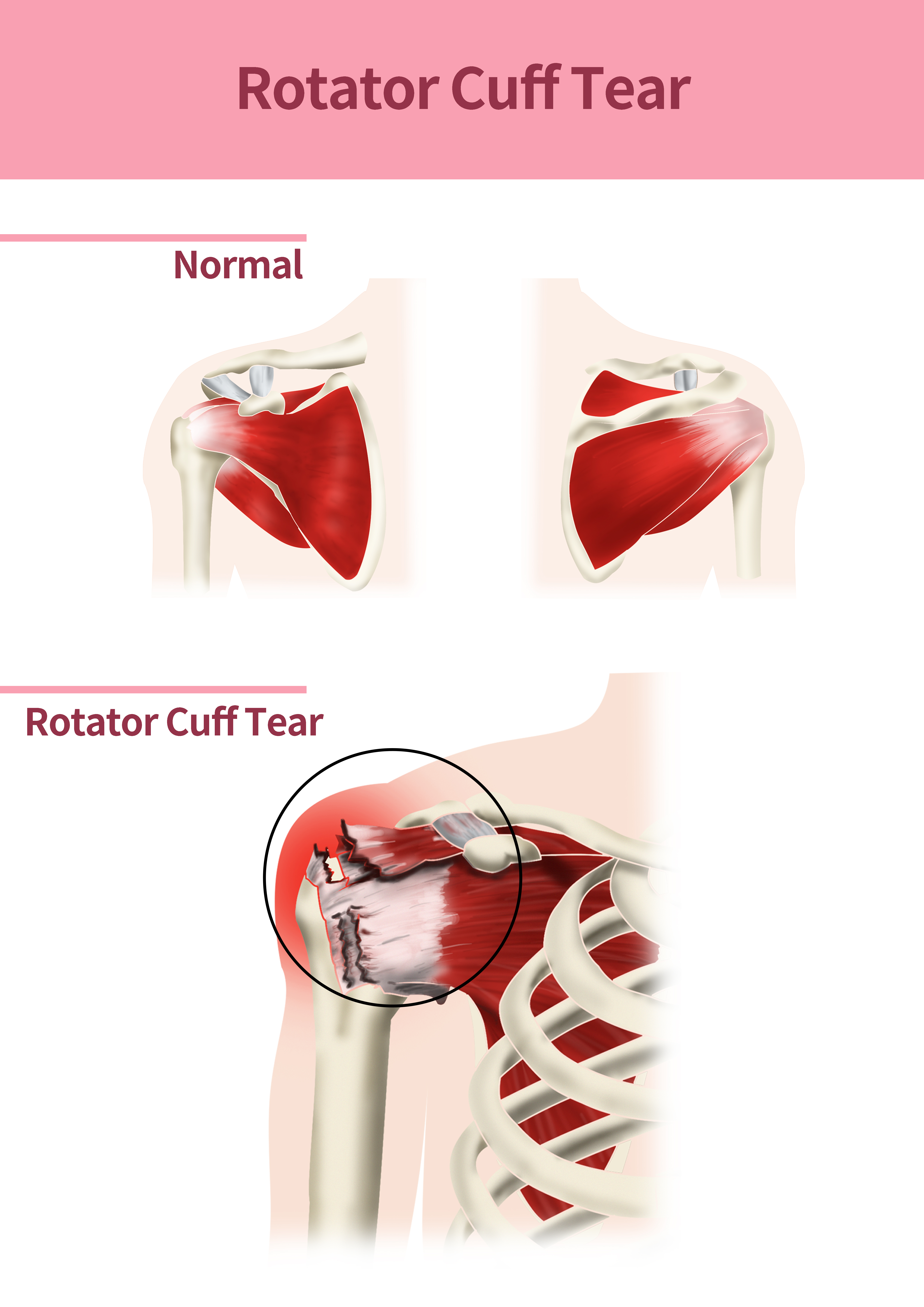 Understanding Rotator Cuff Tears