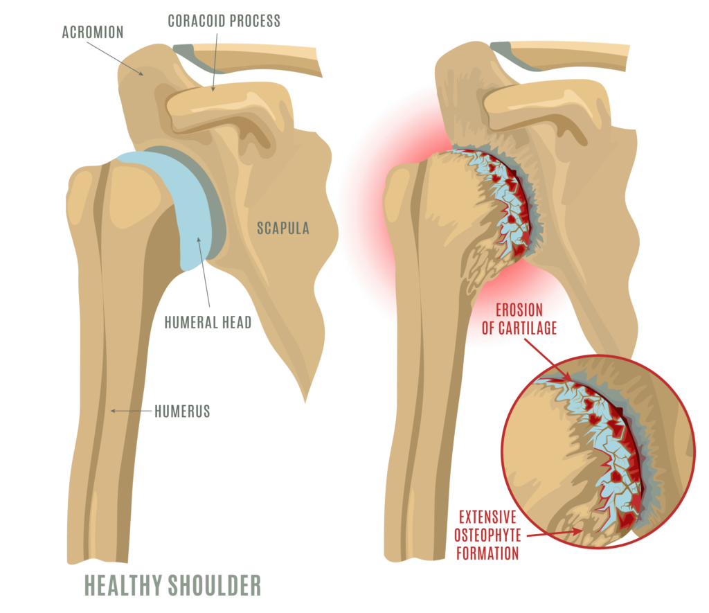 Total Shoulder Replacement What To Expect Kyle Mcclintock Do 5093