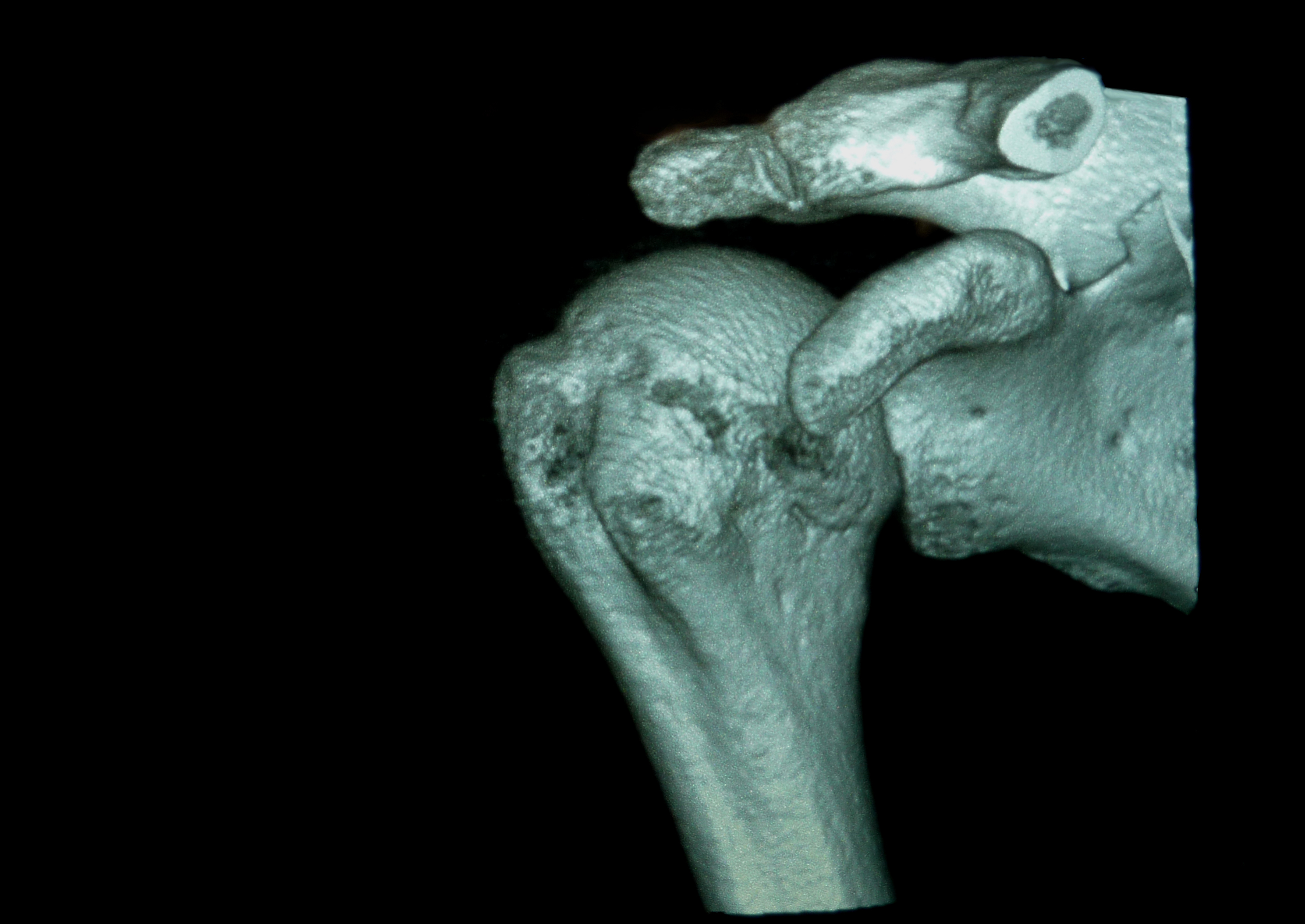 shoulder surgery planning