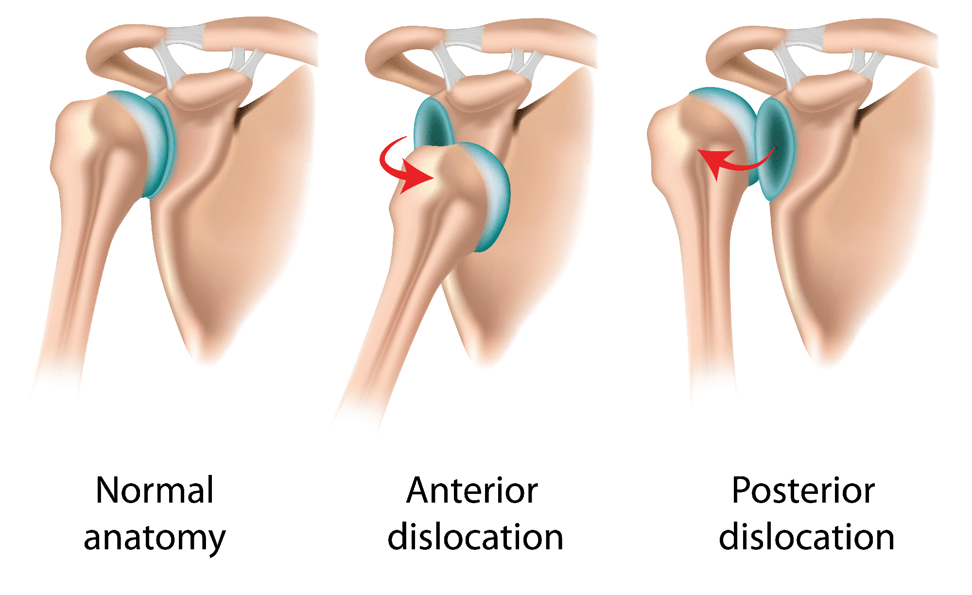 Anatomy of shoulder disability