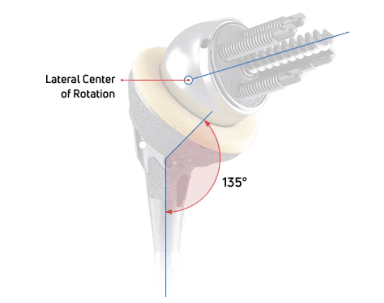 Reverse Shoulder Replacement Faqs Dr Mcclintock Roseville Ca 2973