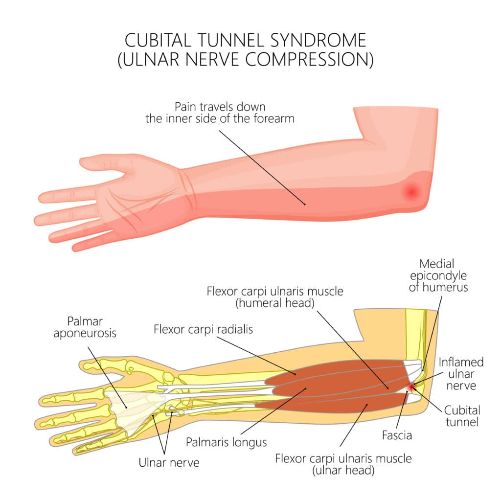 Cubital tunnel syndrom diagram