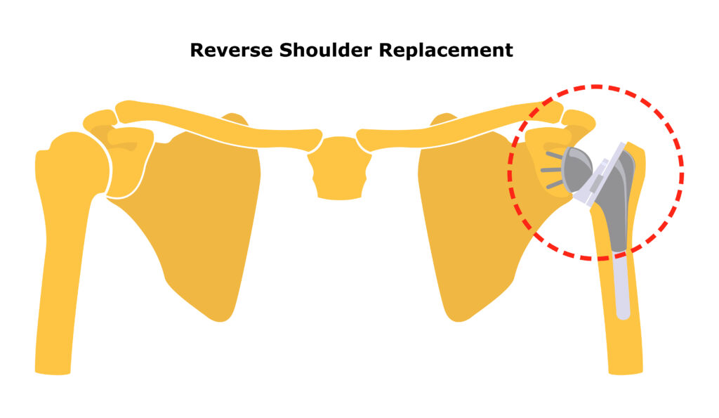 reverse shoulder replacement diagram