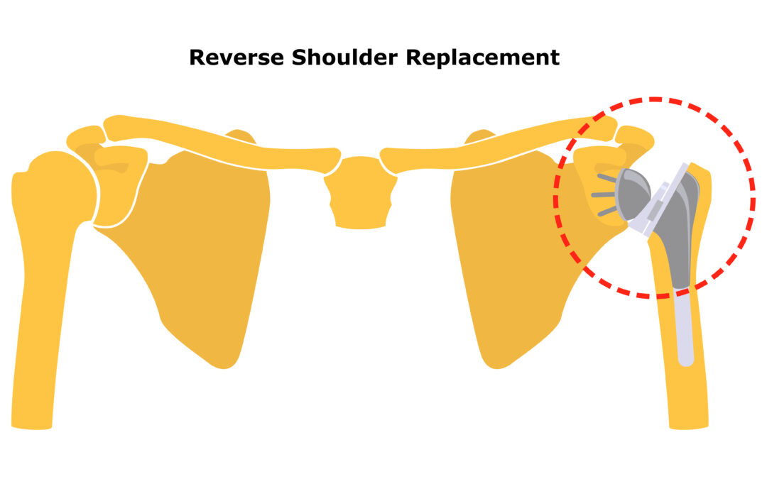 Reverse Shoulder Replacement FAQ’s
