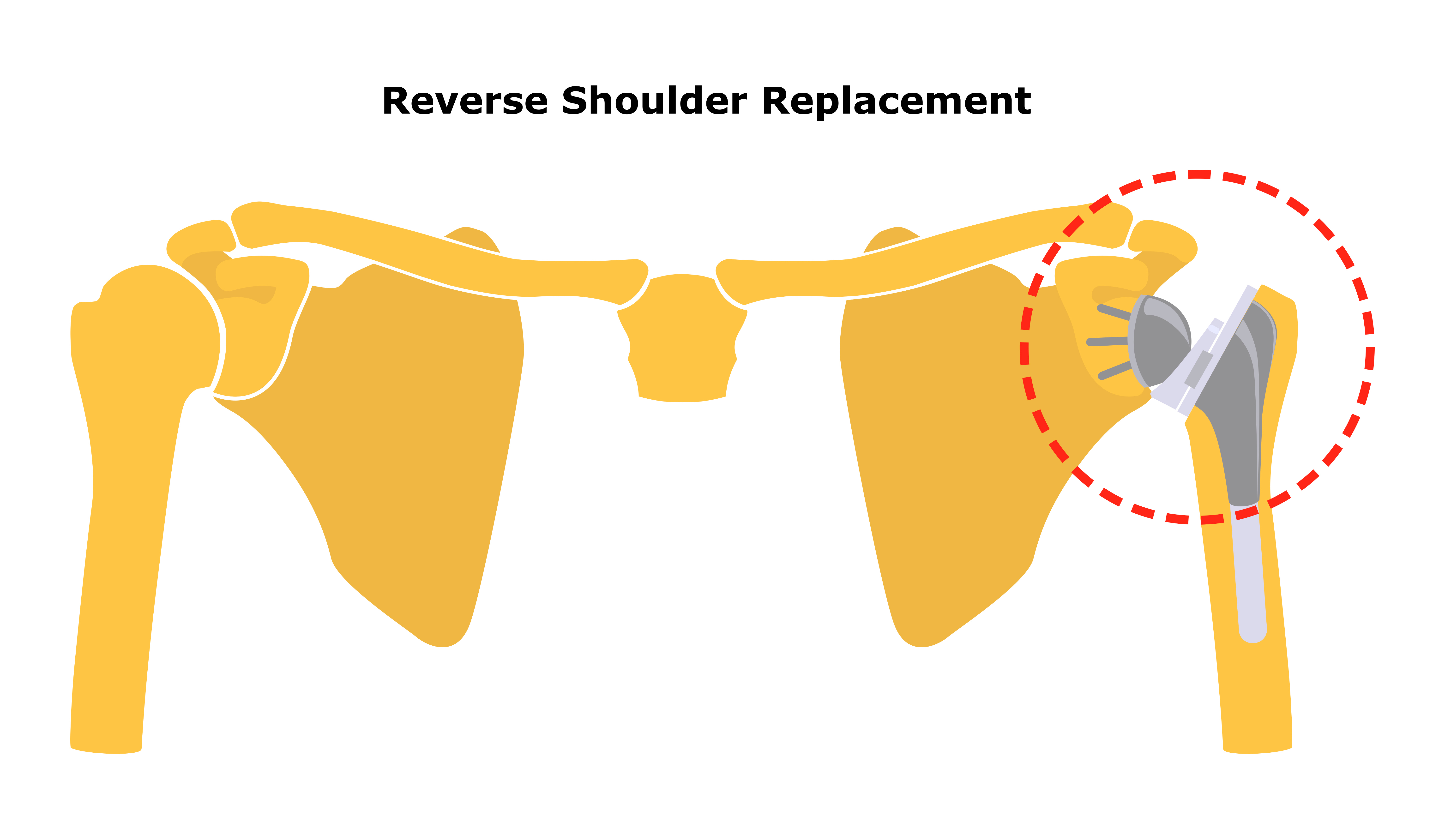 Reverse Shoulder Replacement FAQ’s
