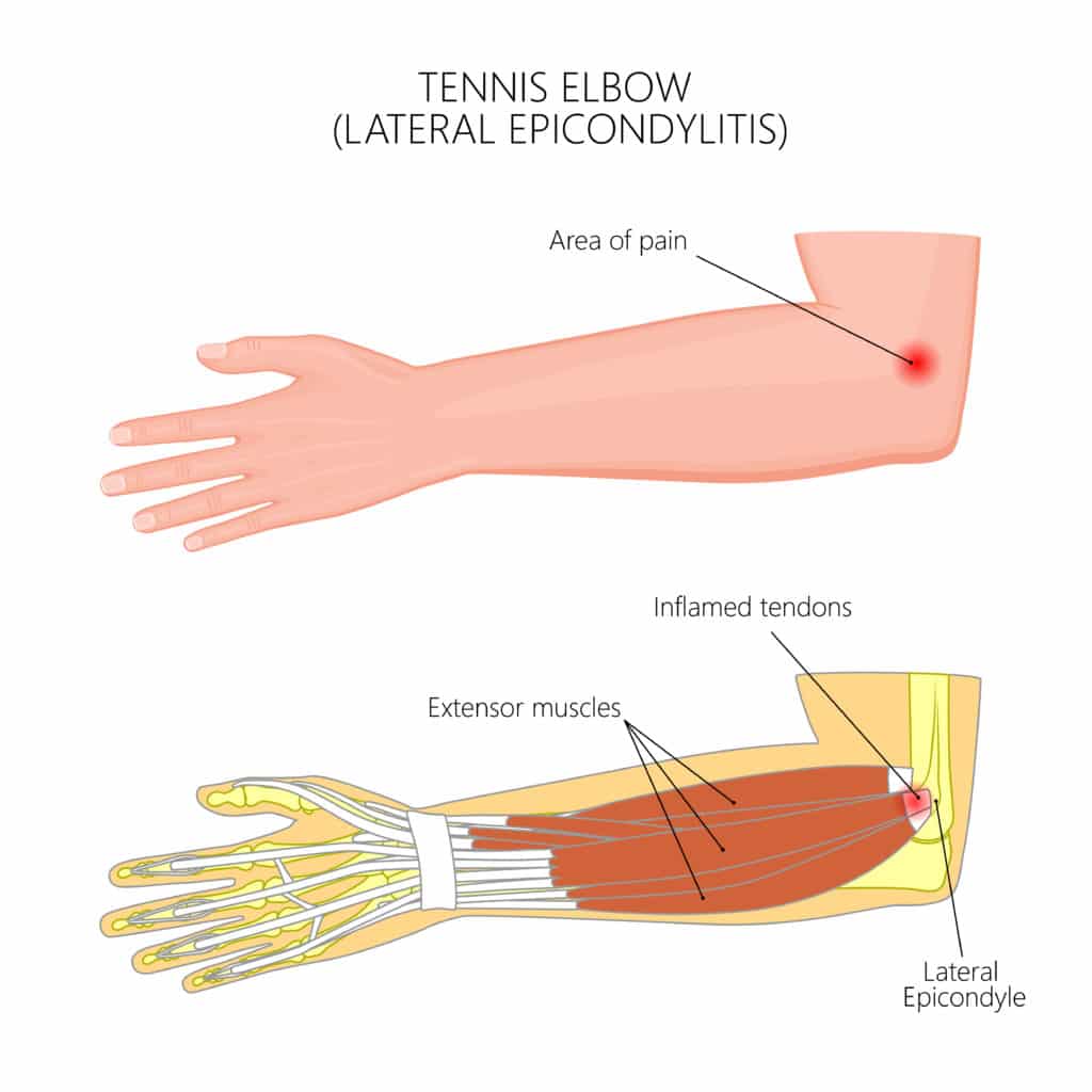 Tennis elbow anatomy