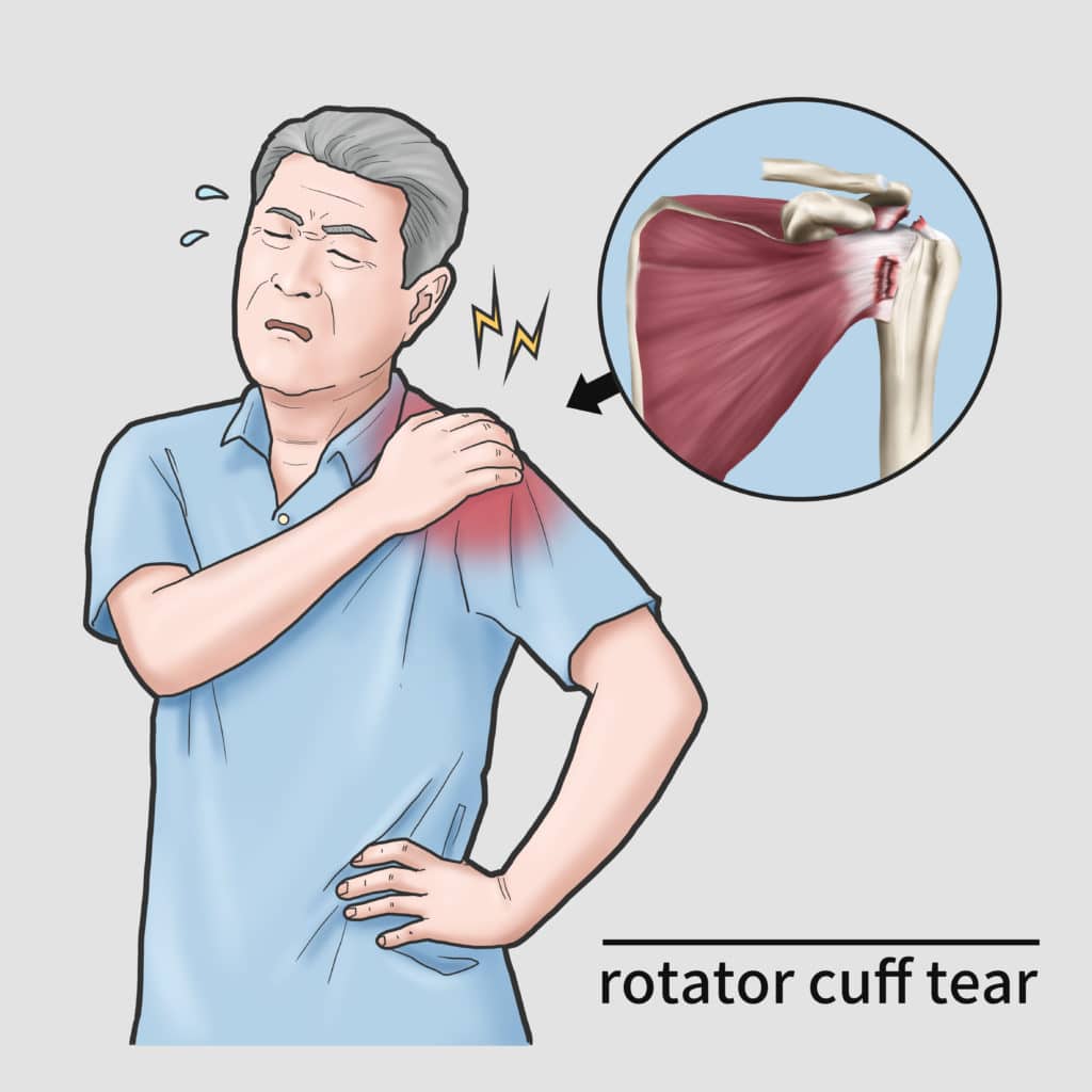 rotator cuff tear