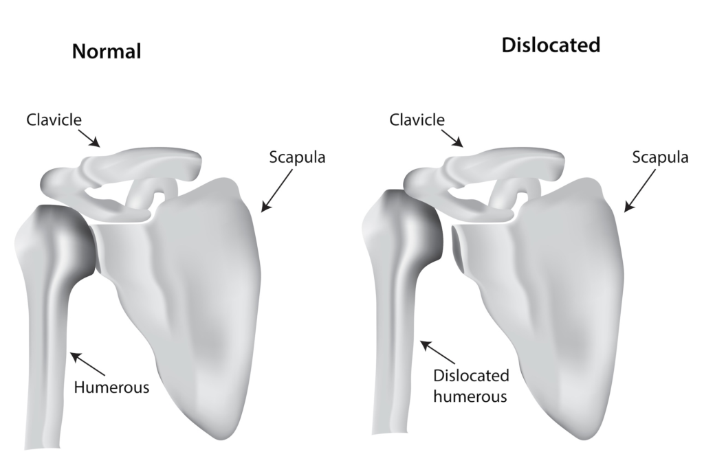 disloacated shoulder instability