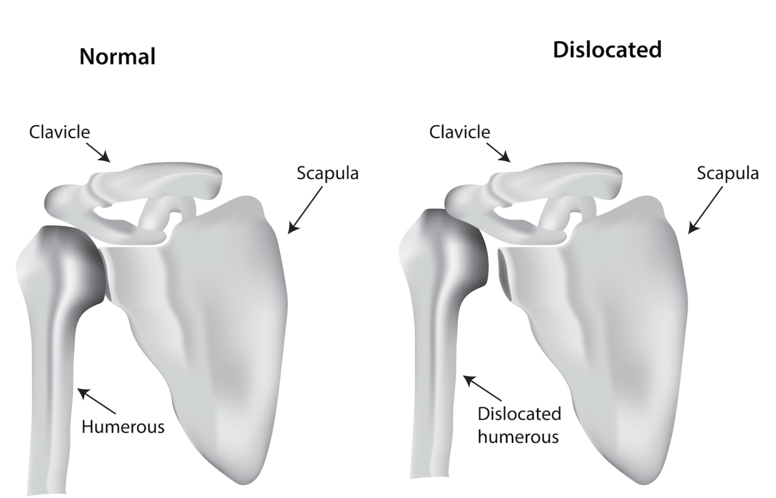 What Is Shoulder Instability? - Kyle McClintock, DO | Orthopedic ...