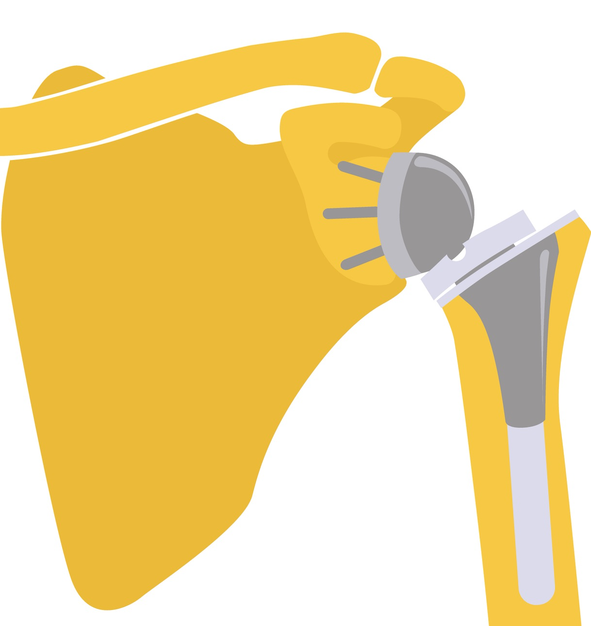 reverse shoulder replacement