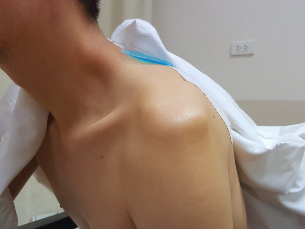 shoulder instability modesto