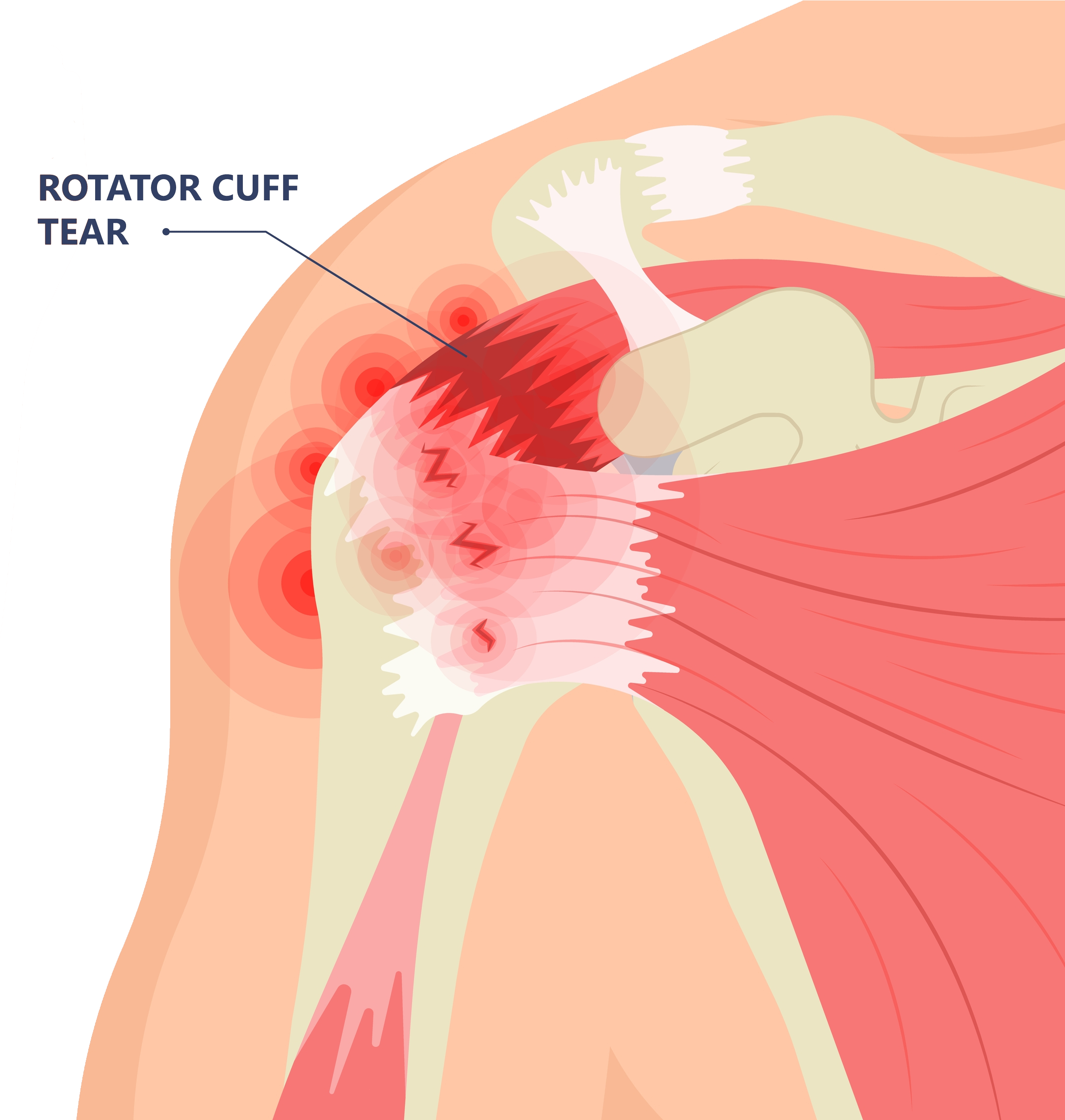 Rotator Cuff Tear? Here’s What You Need To Know!