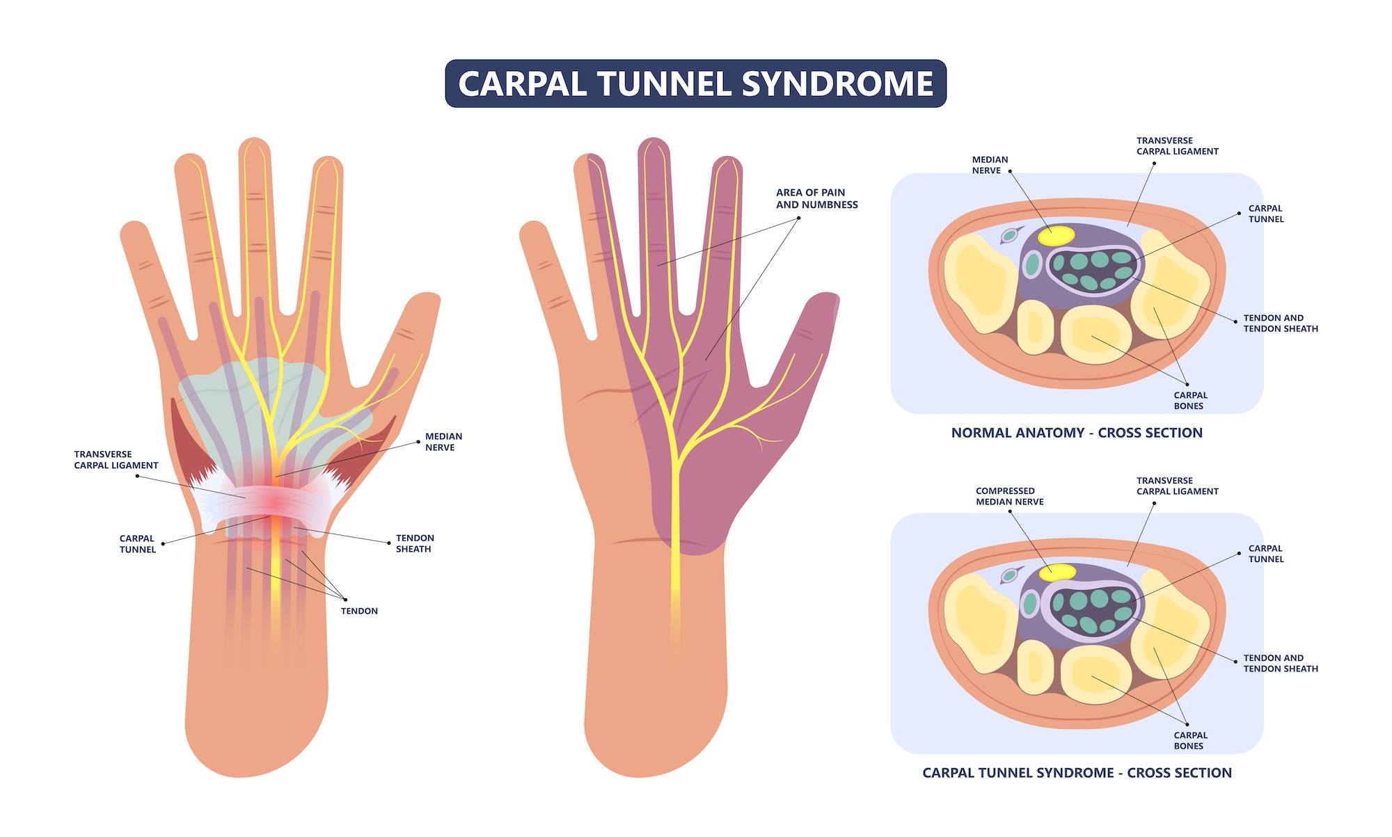 Carpal Tunnel Syndrome Causes Delray Beach, FL