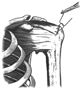 Rotator Cuff Repair Illustration
