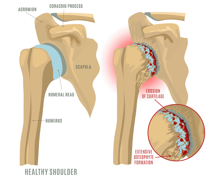 Shoulder Arthritis Illustration