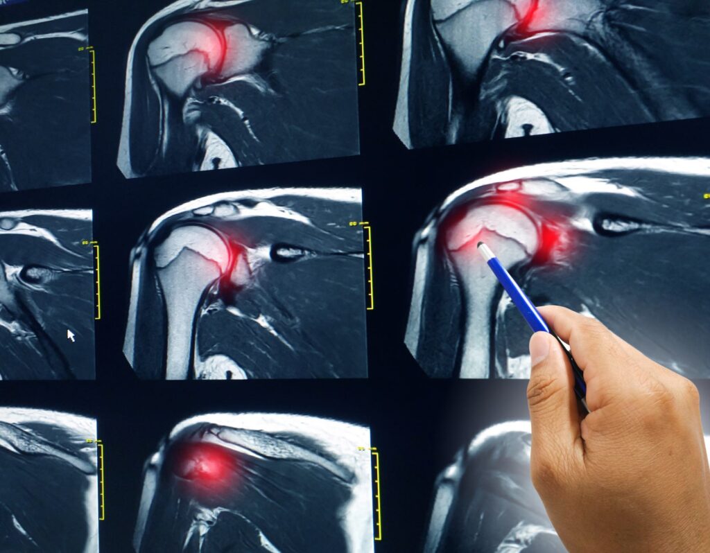 Do x-rays show rotator cuff tear