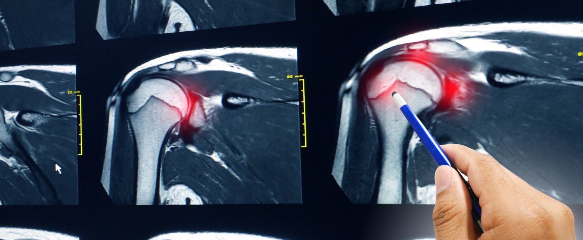 Do x-rays show rotator cuff tear