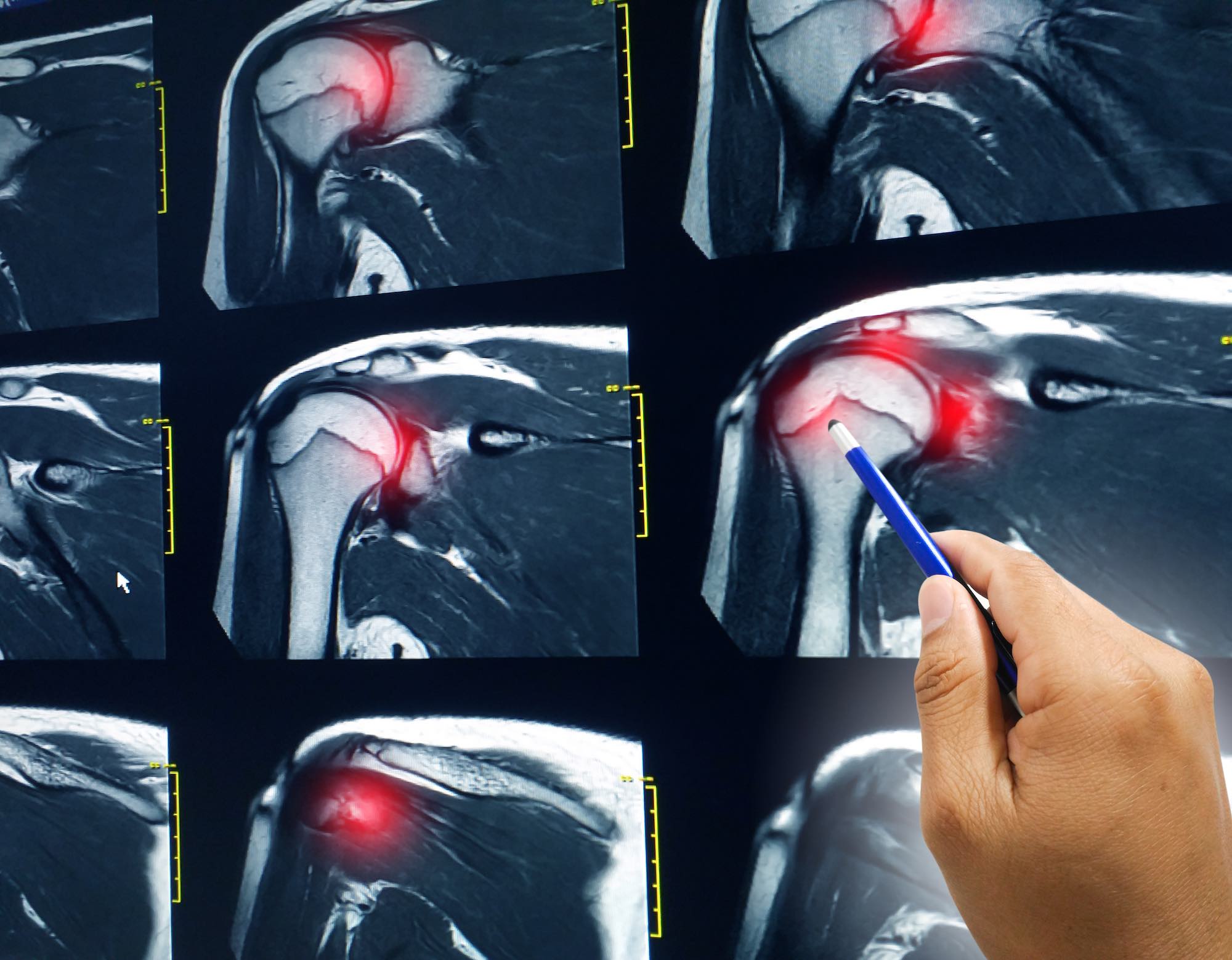 Do X-Rays Show Rotator Cuff Tear?