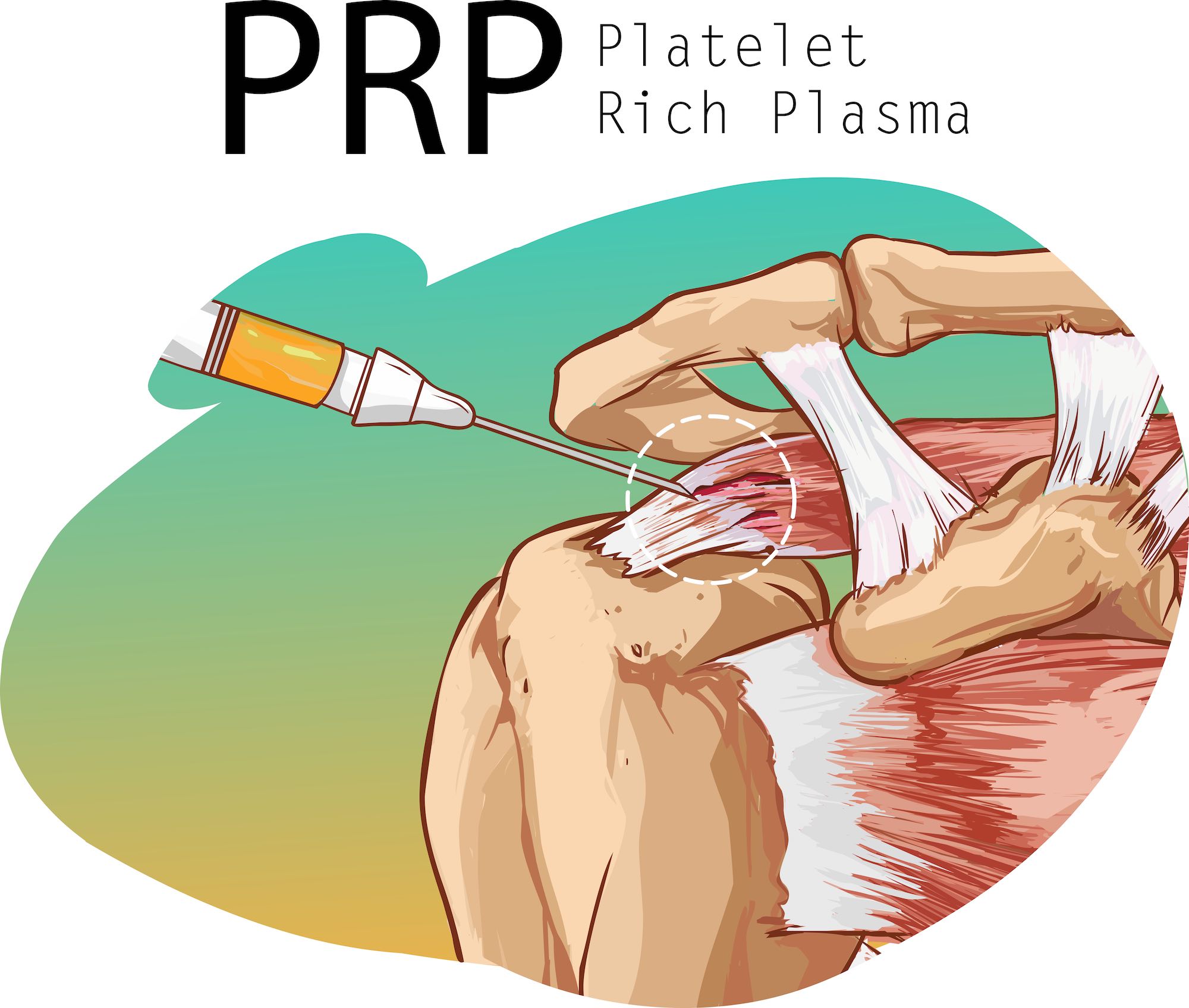 PRP for Rotator Cuff Tear