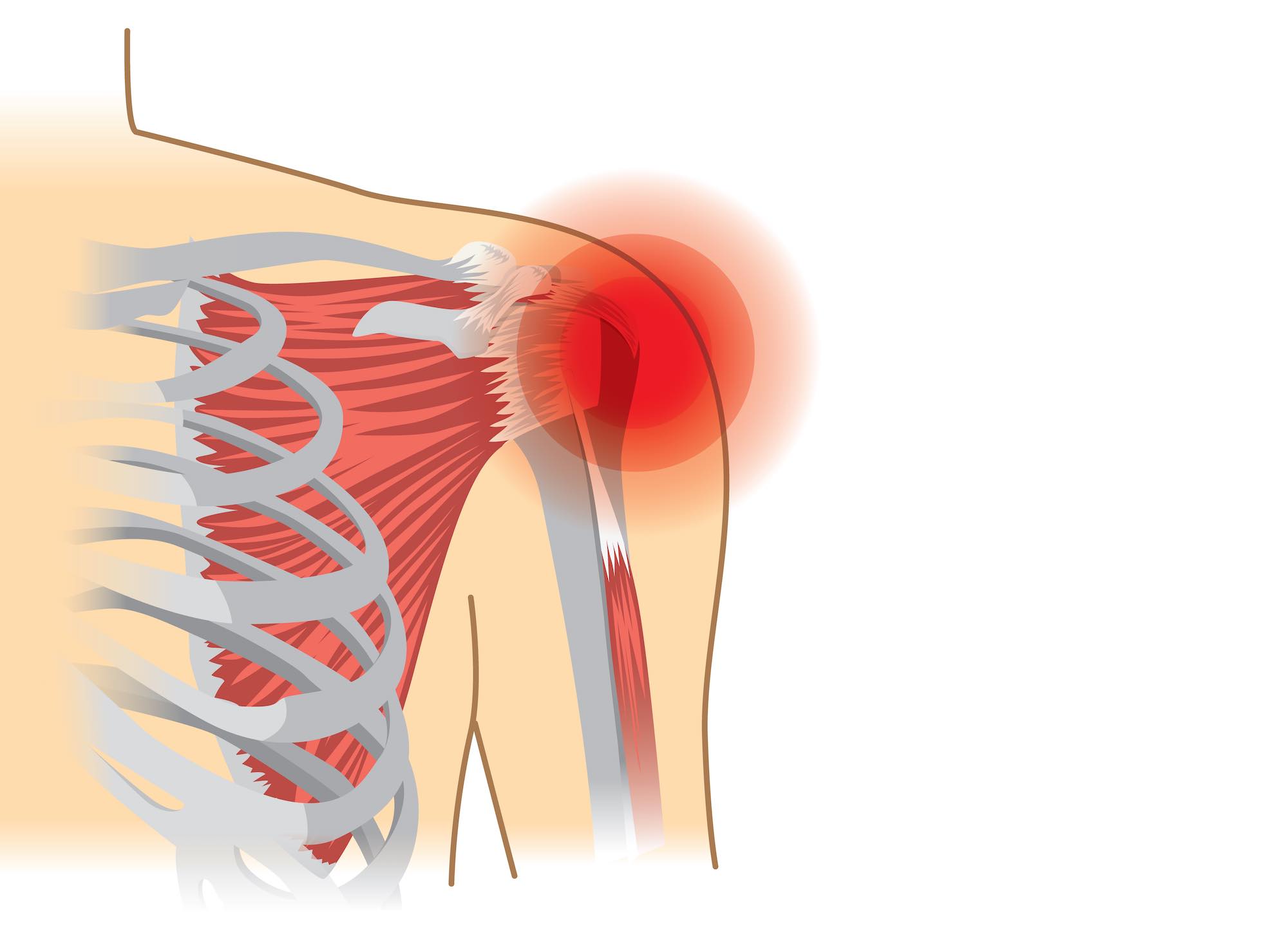 Irreparable Rotator Cuff Tear