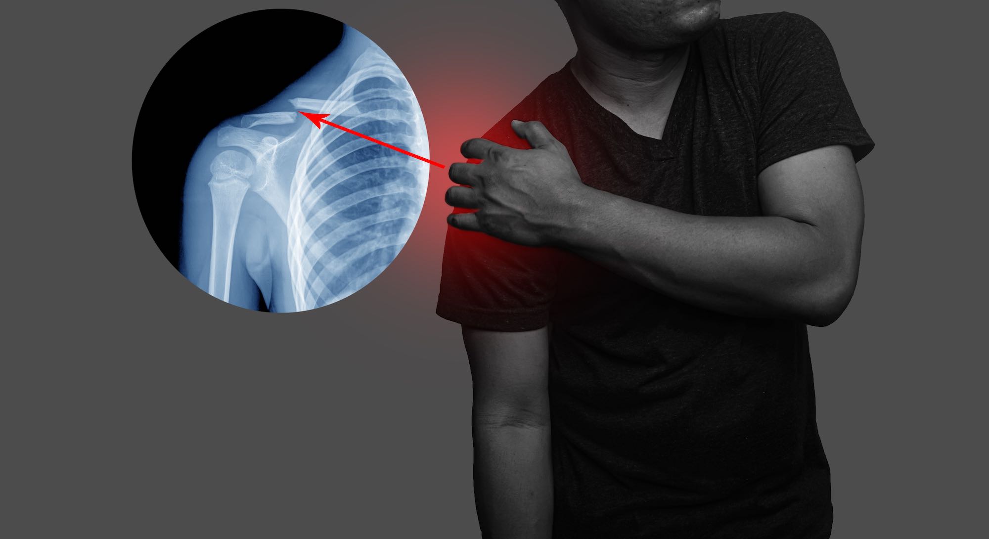 Collarbone (Clavicle) Fracture: Treatment, Symptoms, Recovery and Healing