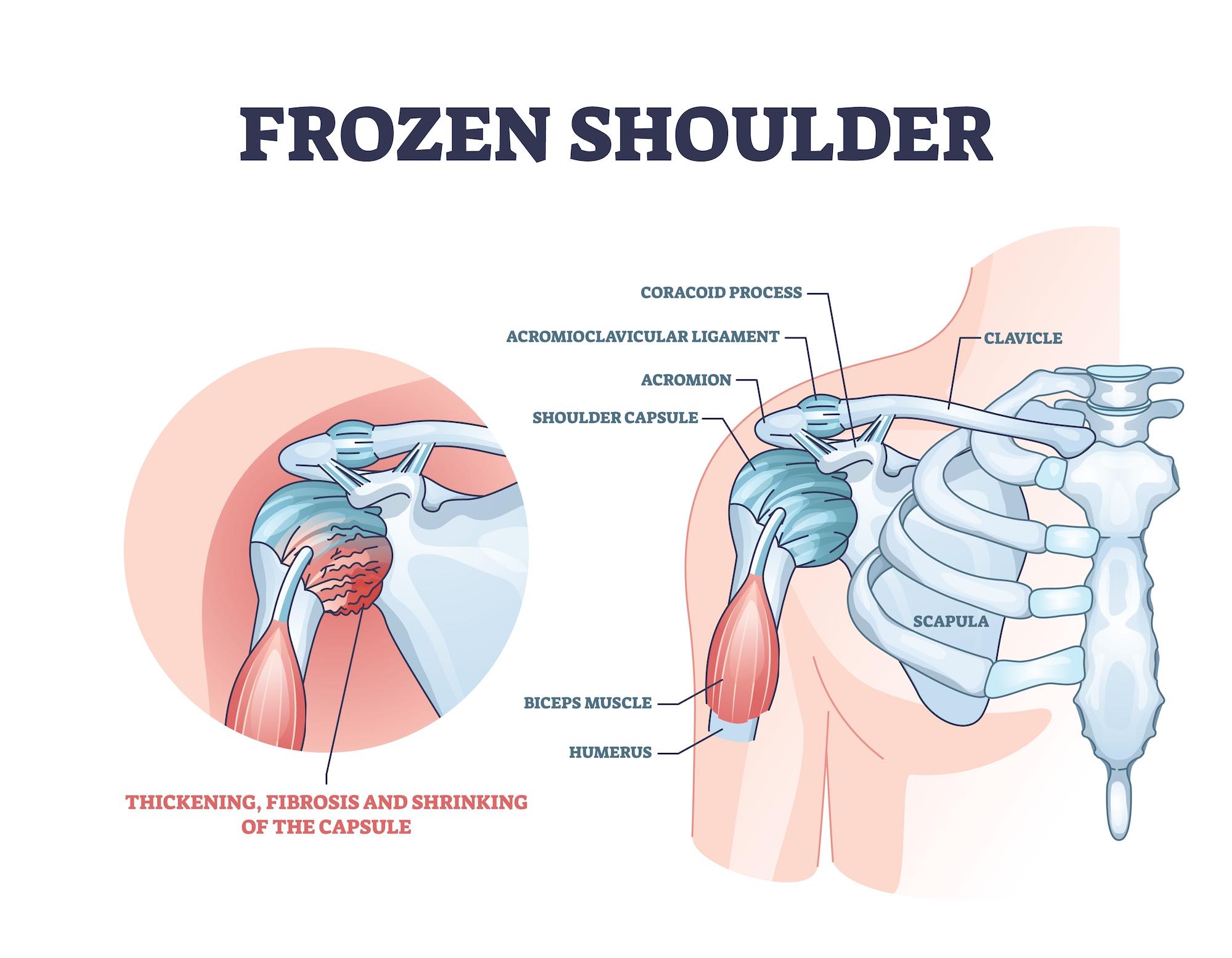 Frozen shoulder condition or adhesive capsulitis syndrome outline diagram. Labeled educational medical diagnosis with pain and stiffness around body upper part with movement illustration