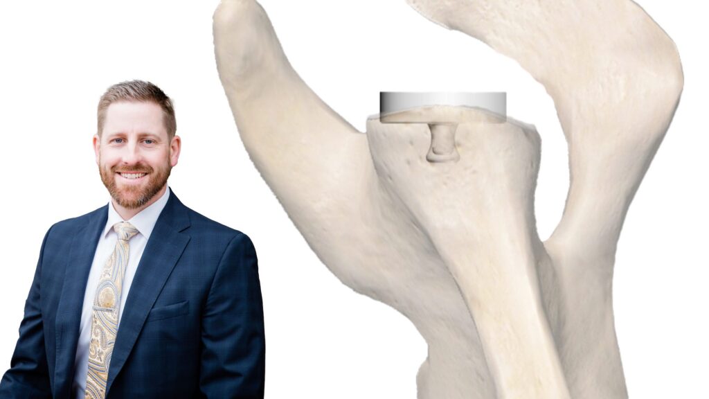 Dr. McClintock with InSet™ glenoid