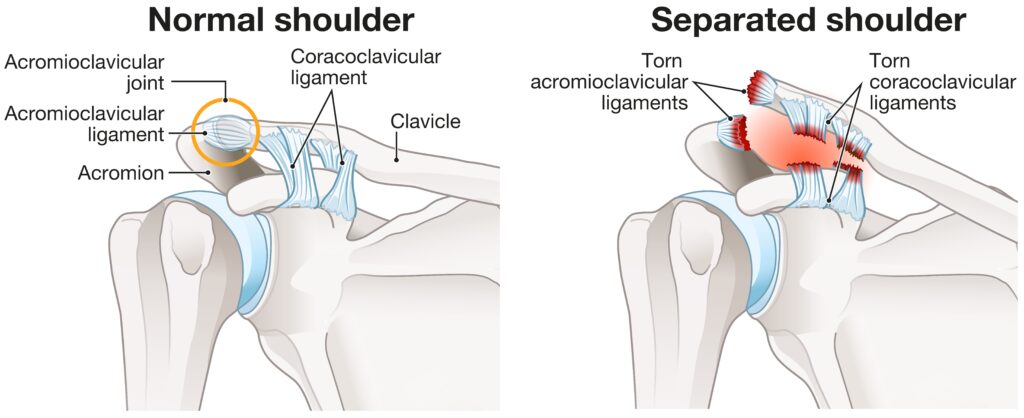 AC joint separation vs normal shoulder joint