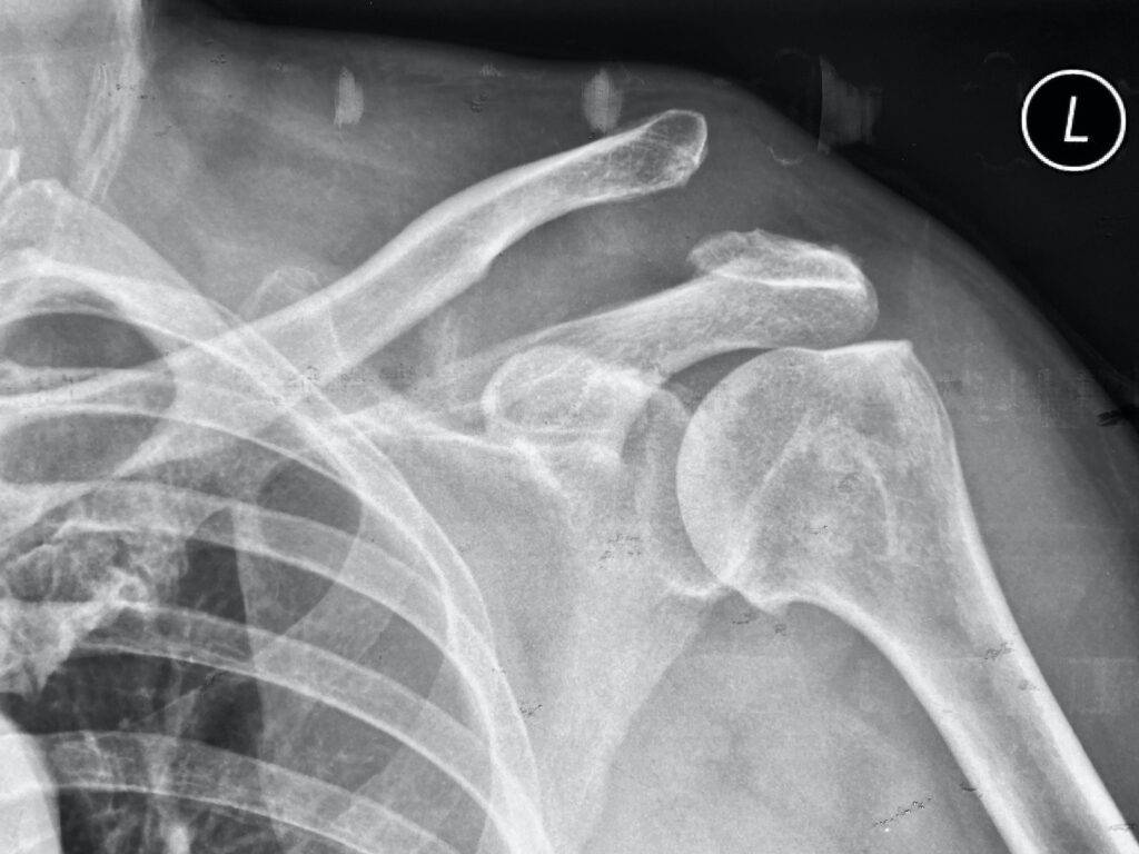 AC joint separation xray
