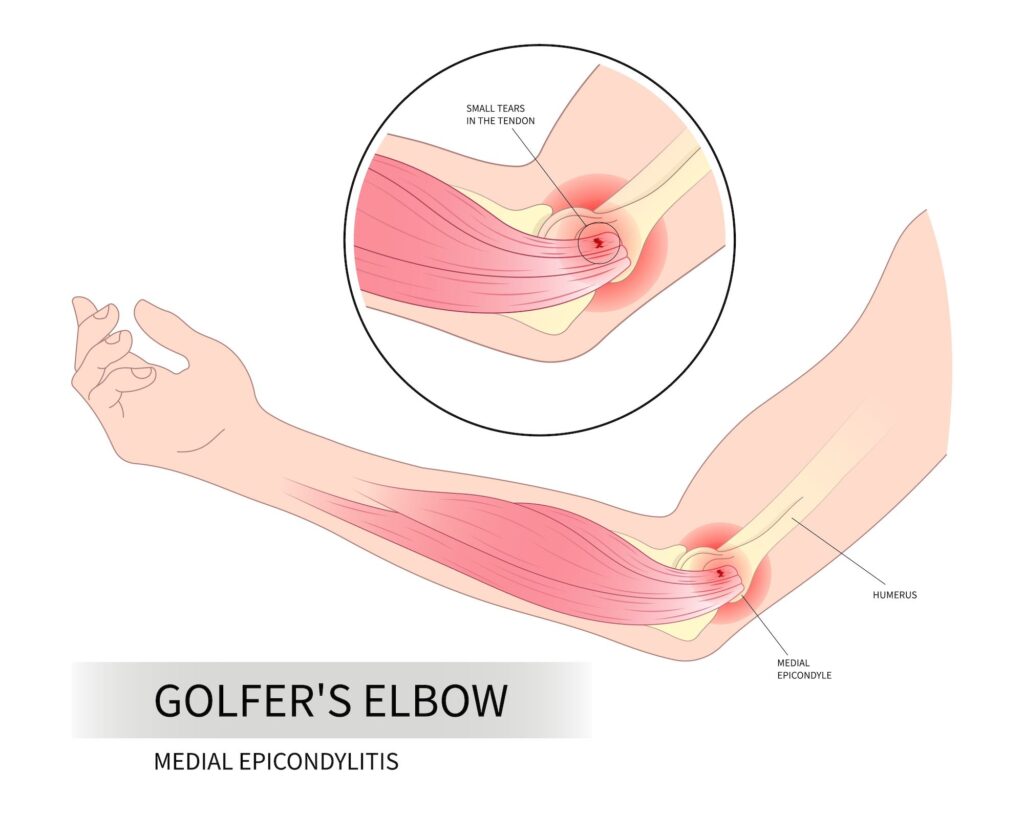 A medical diagram of golfer's elbow