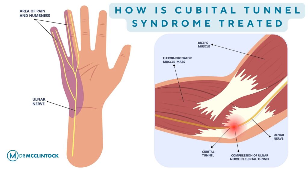 How Is Cubital Tunnel Syndrome Treated