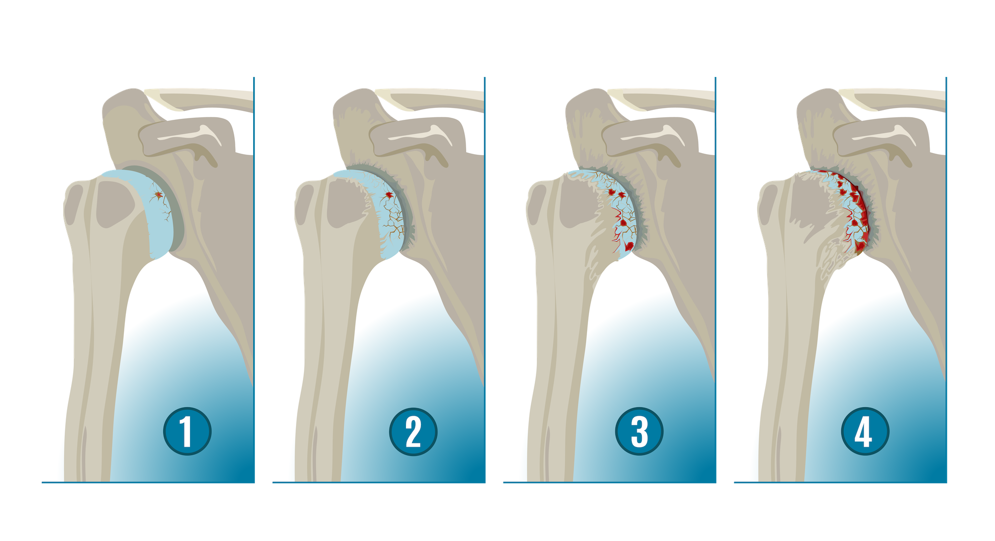 What Causes Arthritis in the Shoulder? Anatomical graphic displaying the steps of shoulder arthrtis