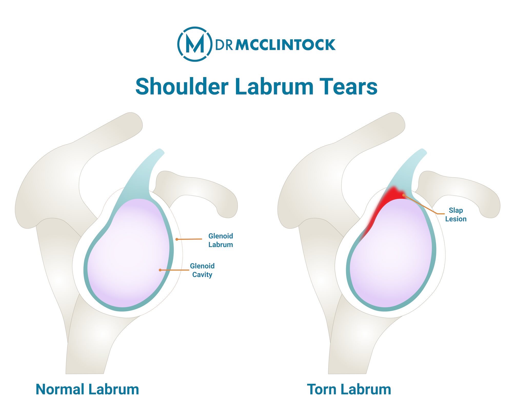 Shoulder Labrum Anatomy