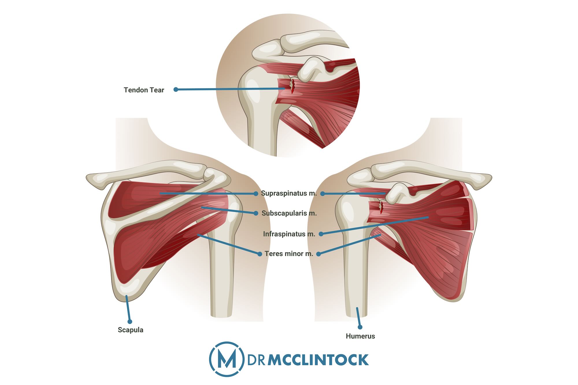 Rotator Cuff Injury Anatomy for testing at home