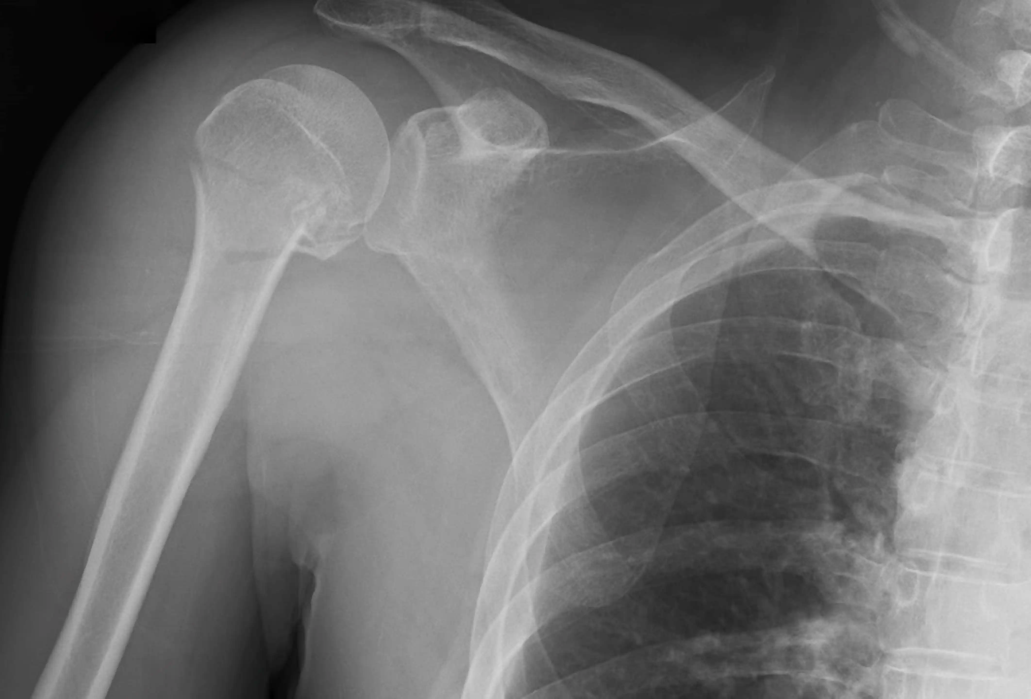 Proximal Humerus Fracture