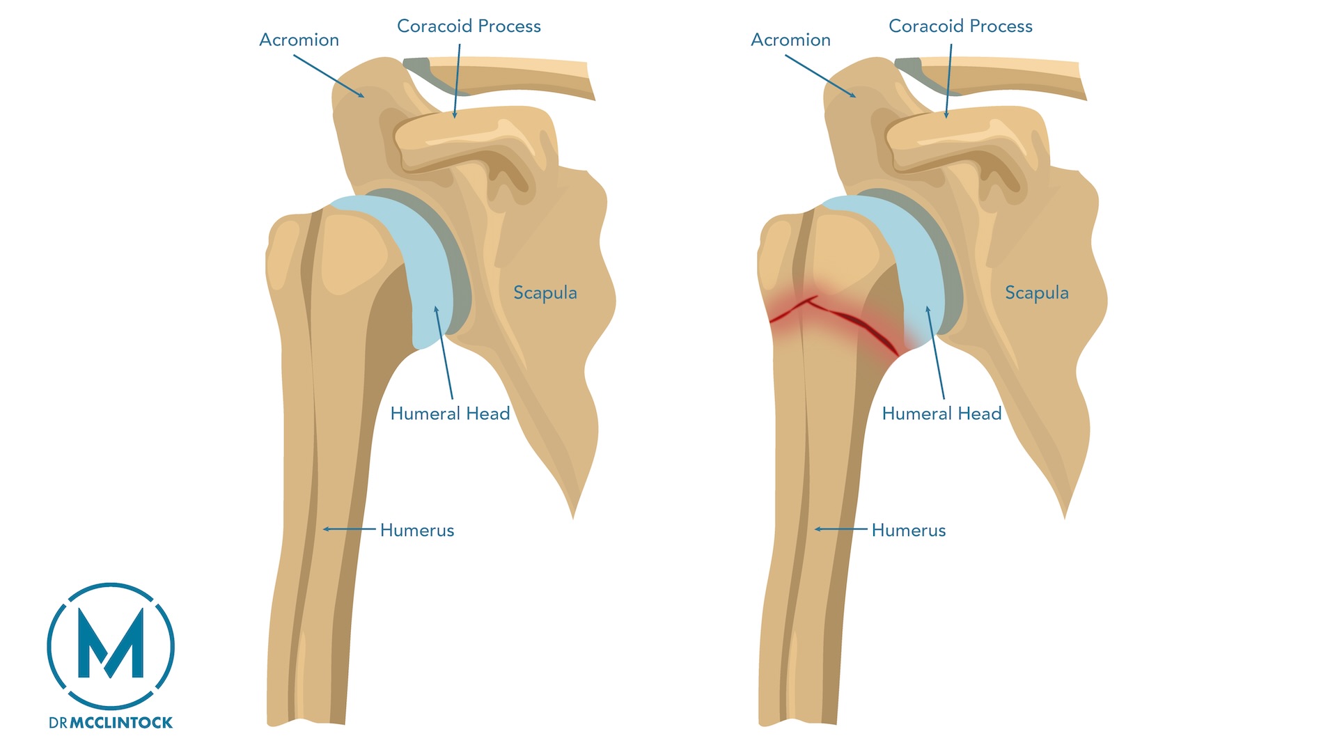 Proximal Humerus Fracture Anatomy