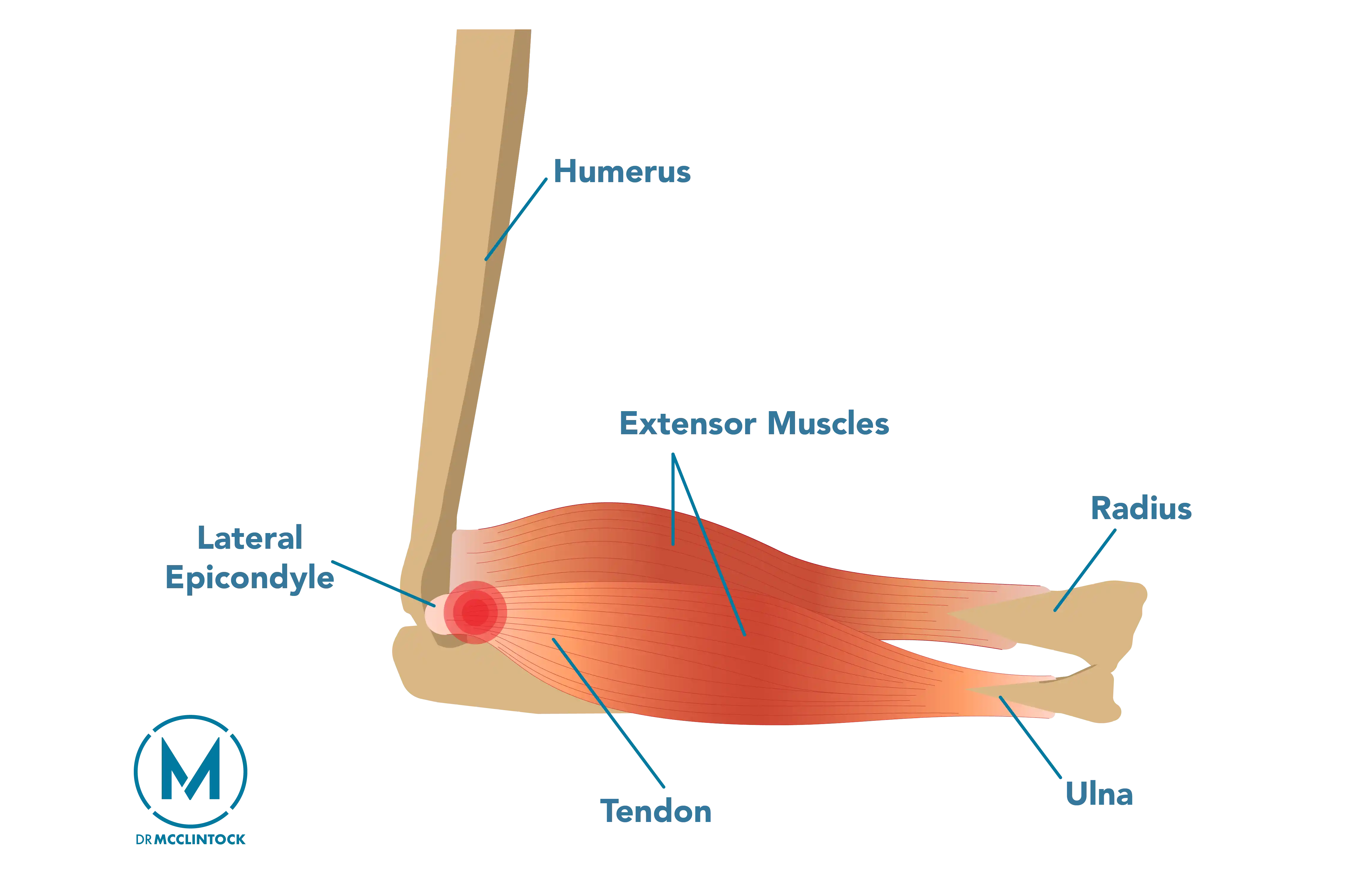 Elbow Tendonitis Anatomy