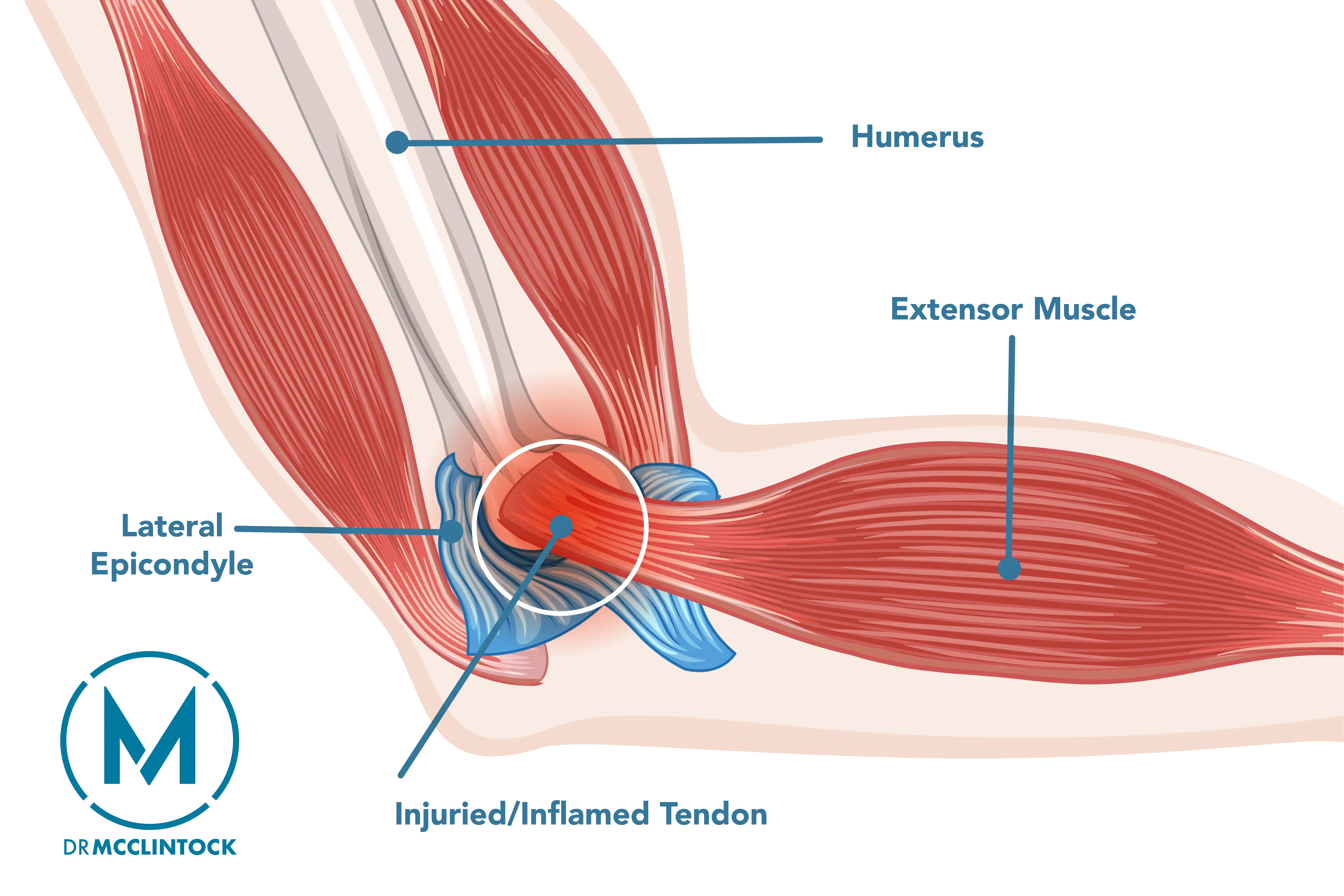 Extensor Tendon Tear Anatomical Graphic