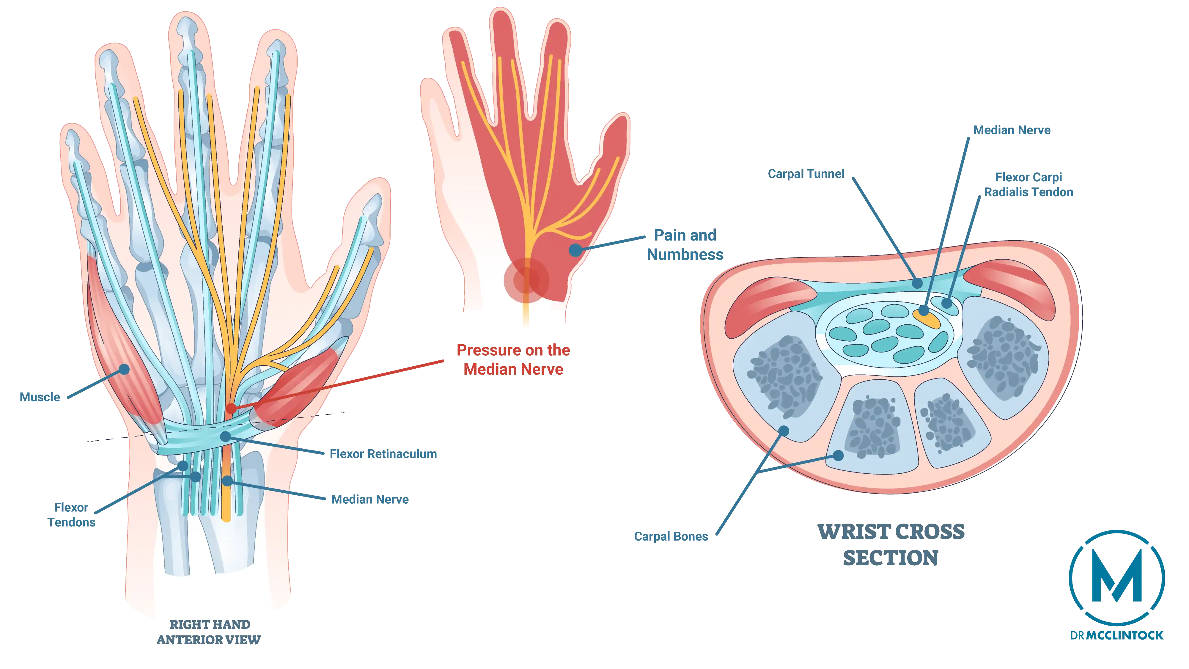 Anatomical Graphic of Carpal Tunnel Syndrome