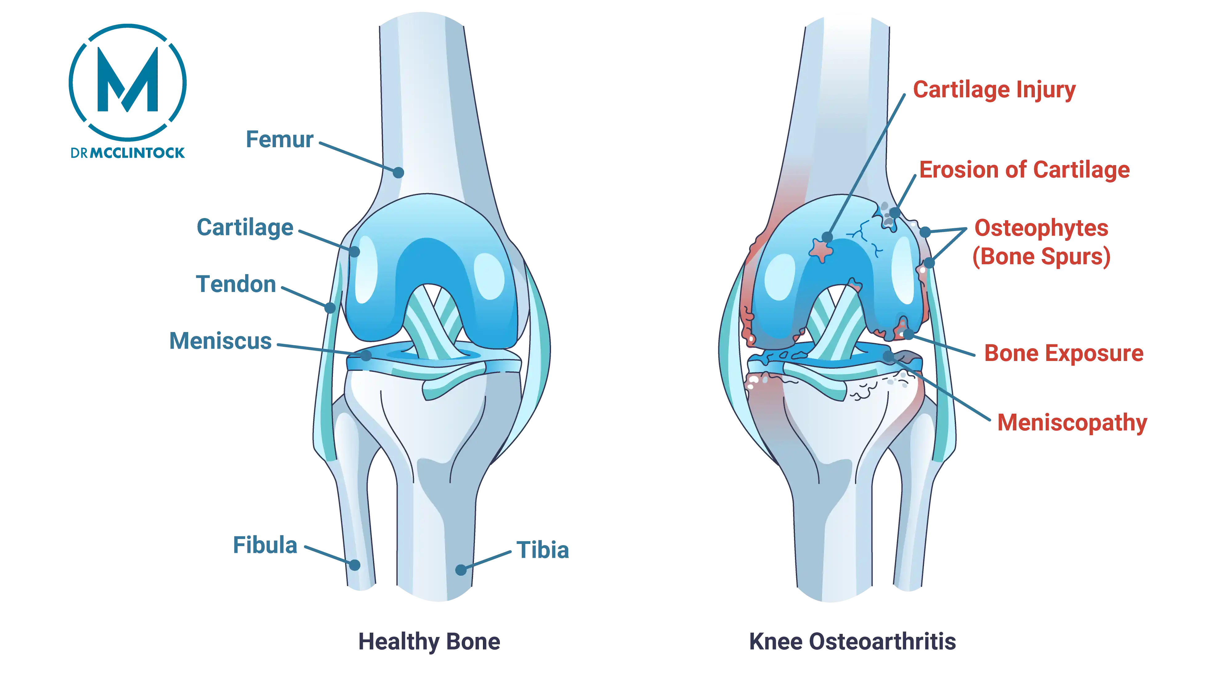 Osteoarthritis Anatomical Graphic