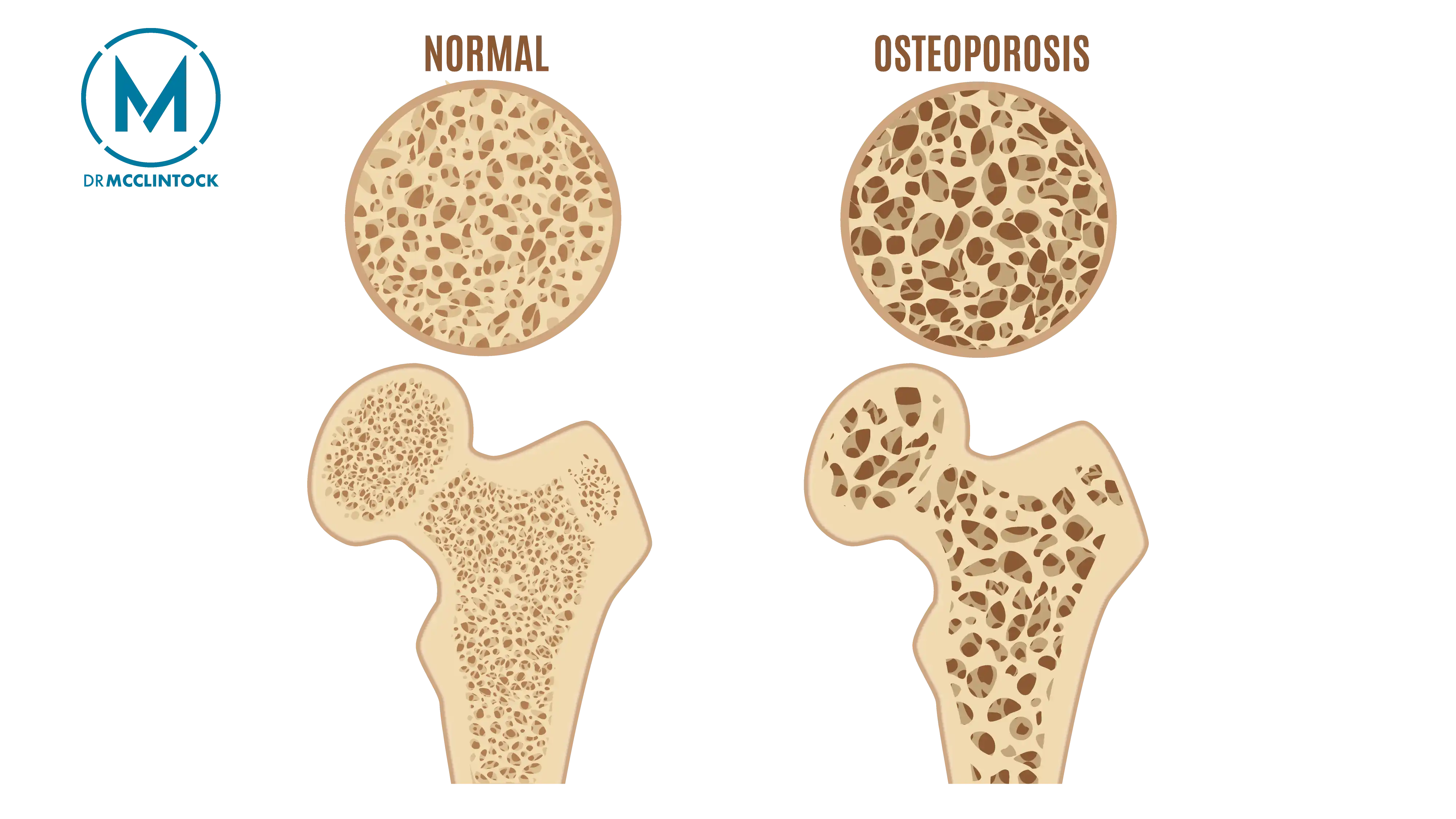 Osteoporosis Anatomical Graphic