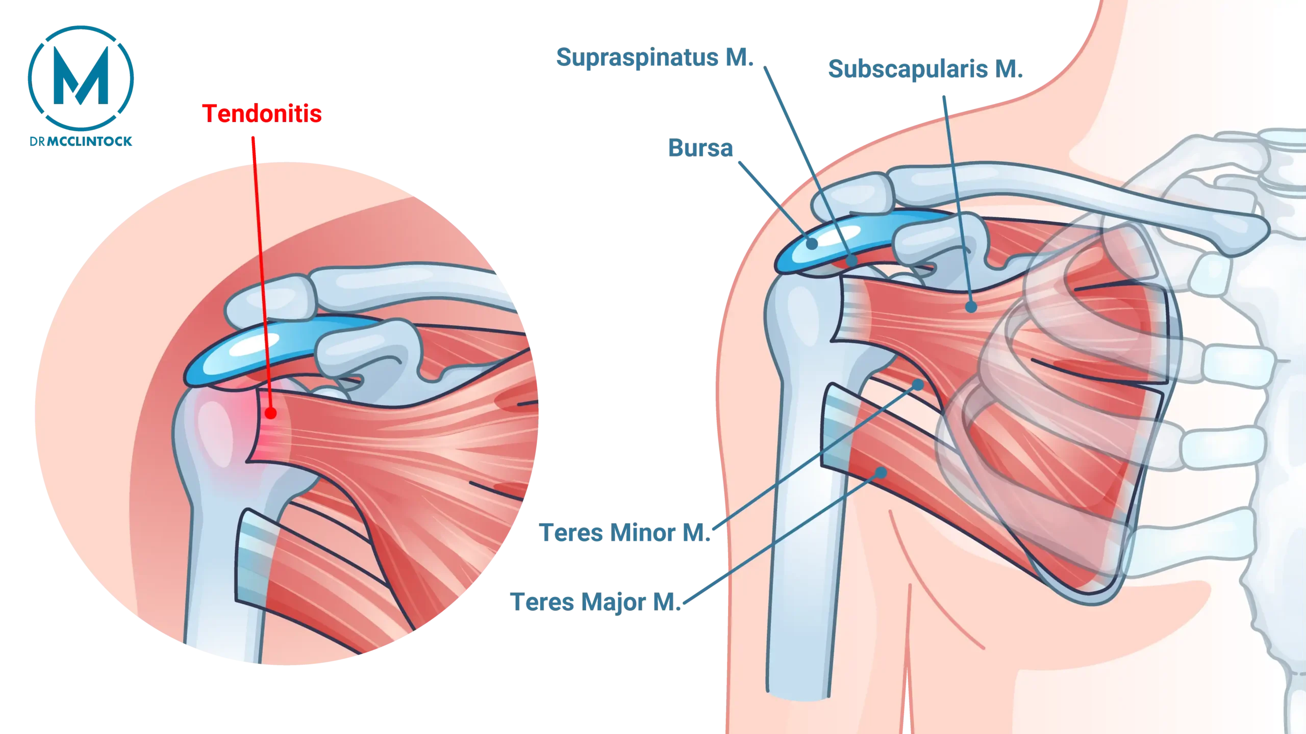 Anatomical Graphic of Rotator Cuff Tendinitis