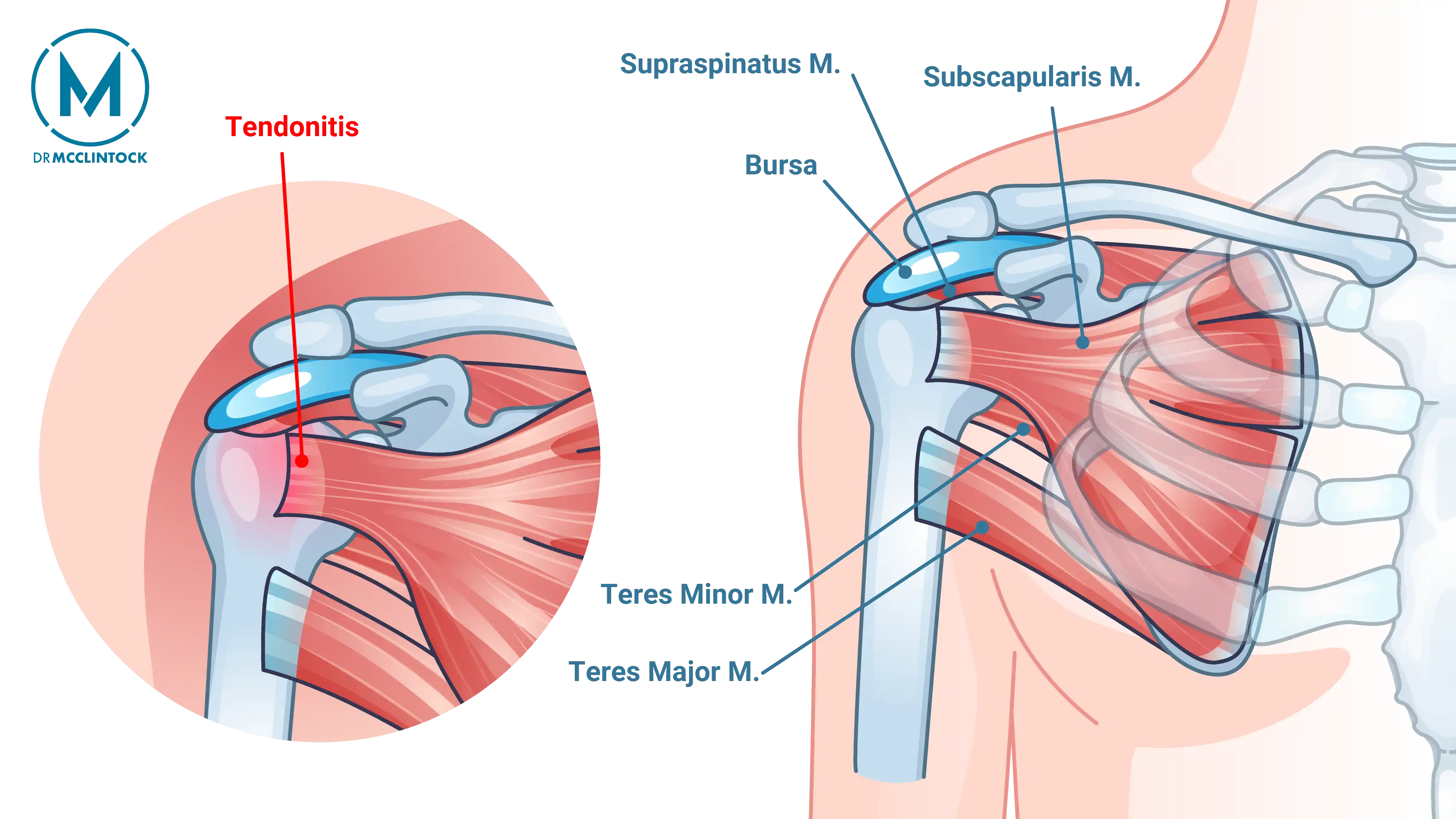 Anatomical Graphic of Rotator Cuff Tendinitis