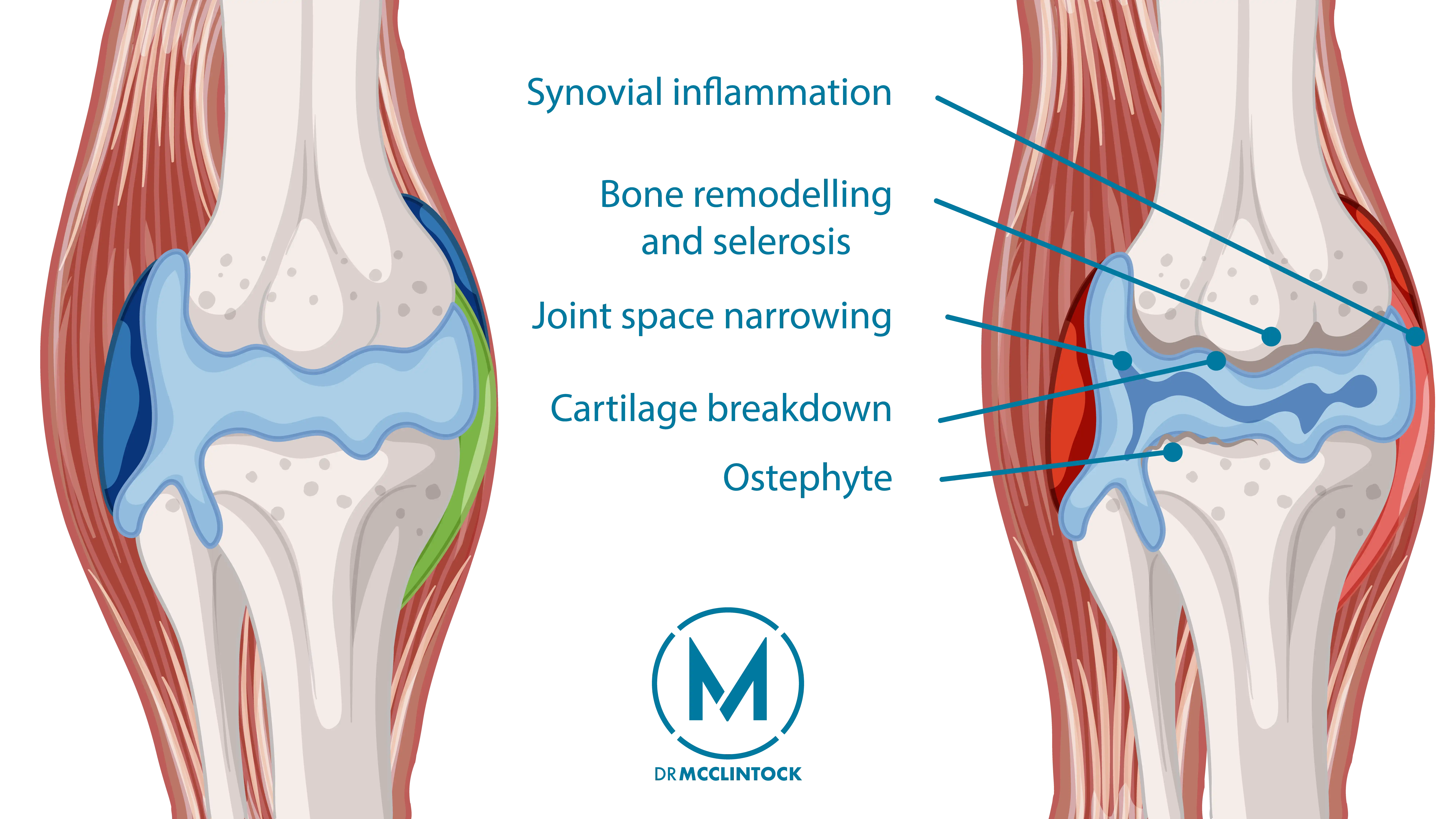Can Arthritis Lead to Tennis Elbow? Anatomical graphic of Elbow Arthritis