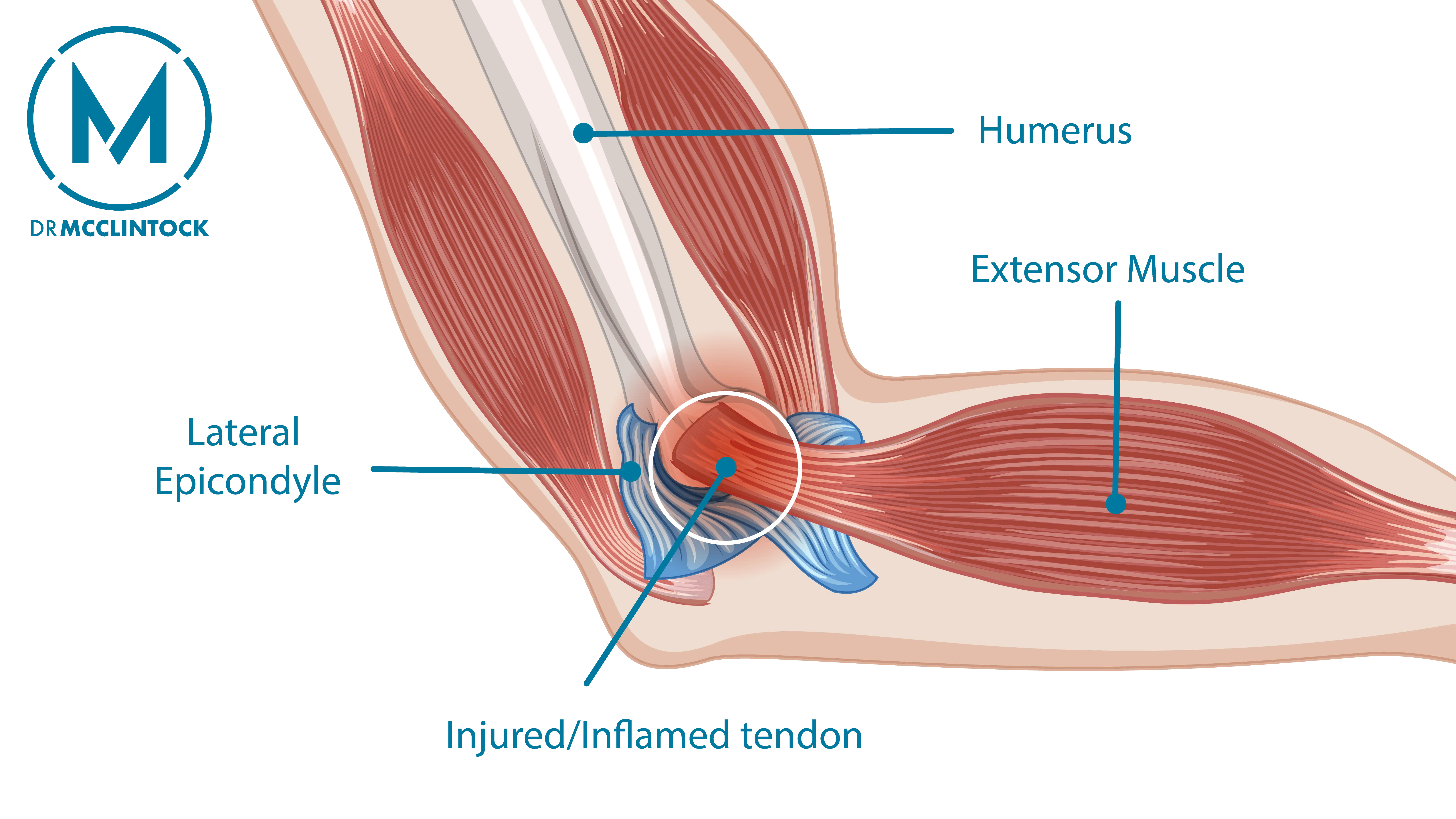 Anatomical graphic of Tennis Elbow