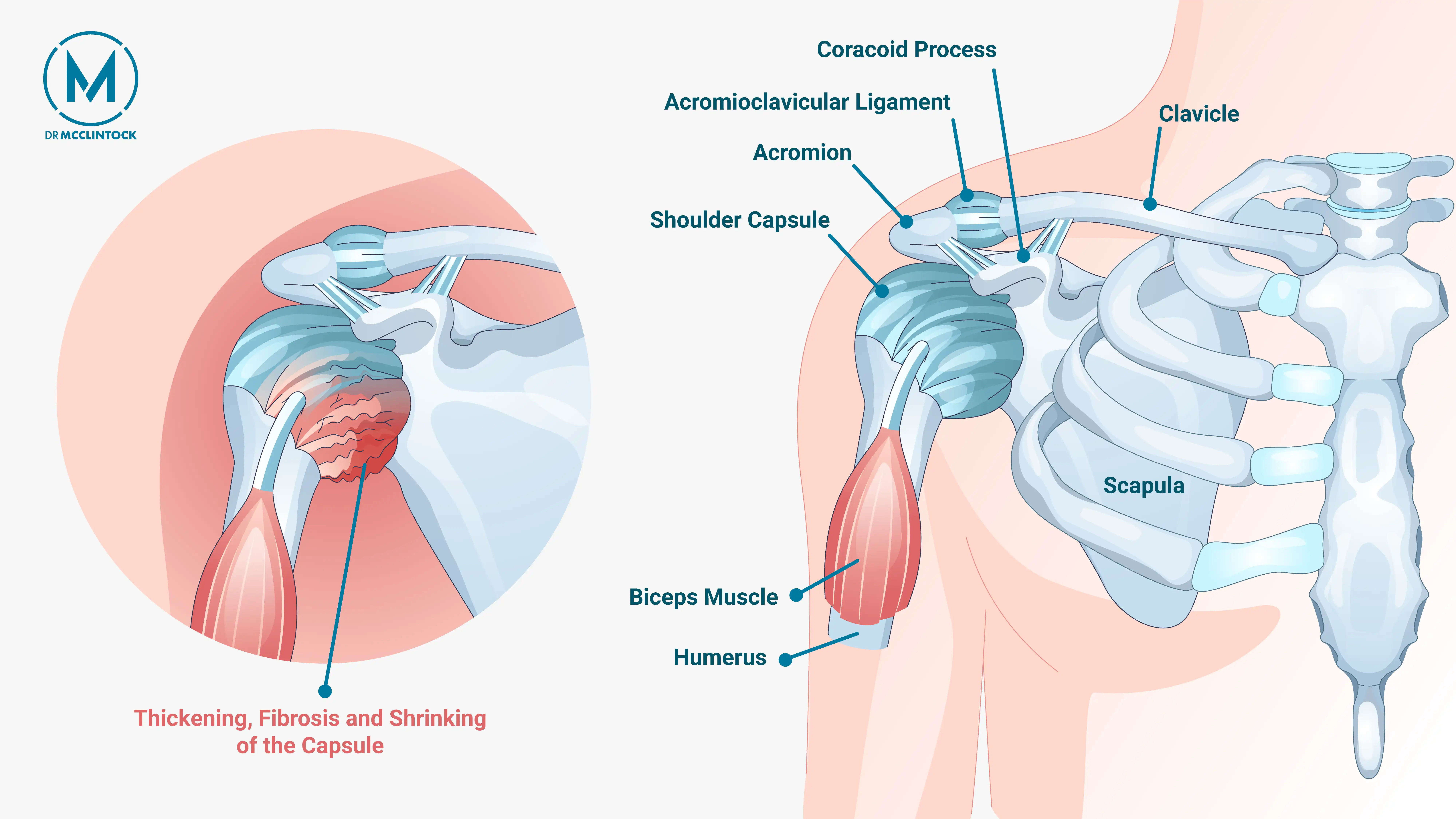 Anatomical graphic of frozen shoulder