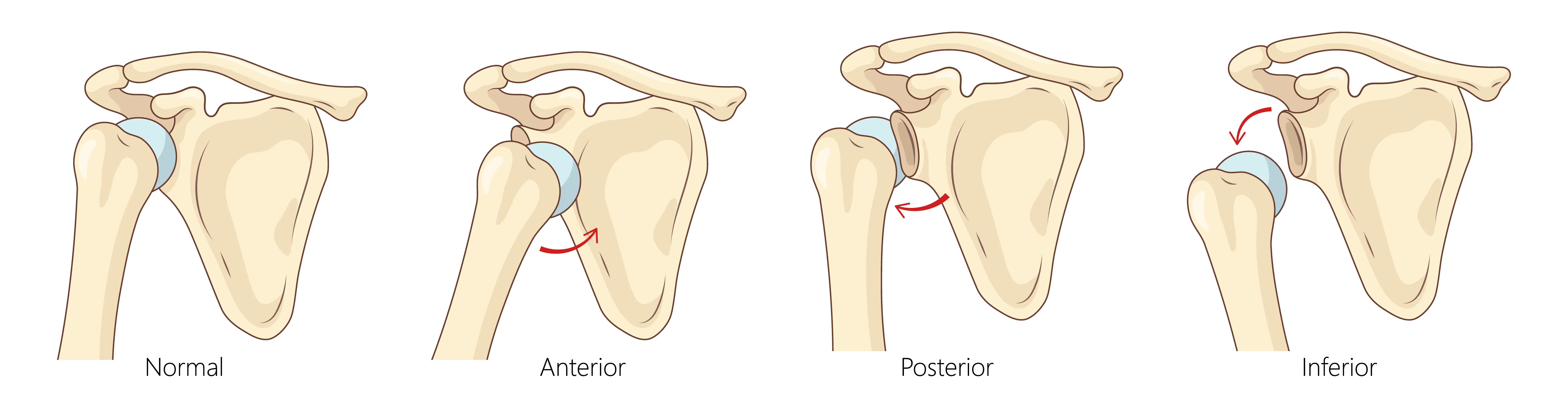 Anatomical Graphic of Shoulder Dislocation