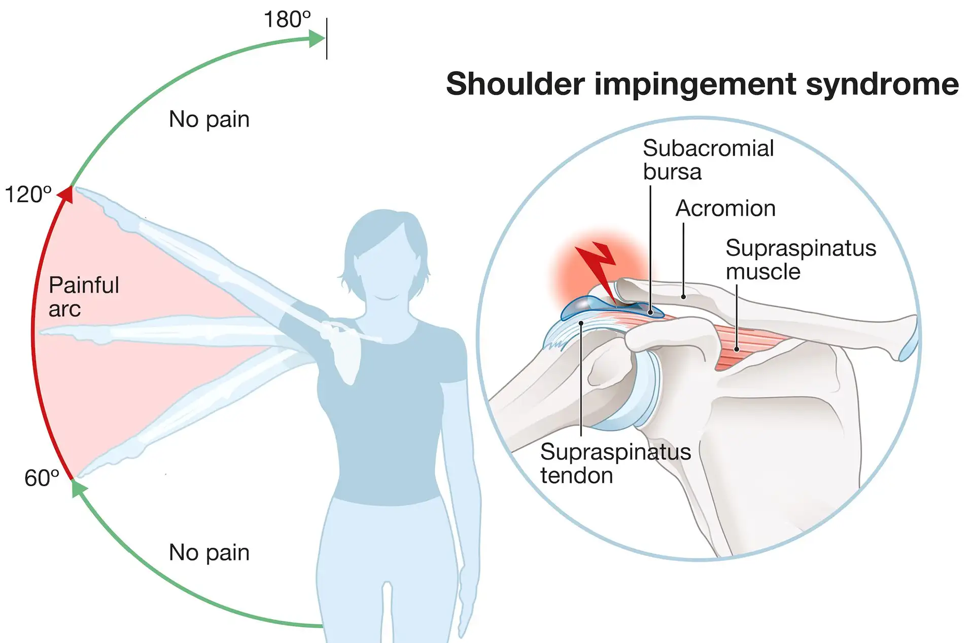 Anatomical Graphic of Shoulder Impingement Syndrome